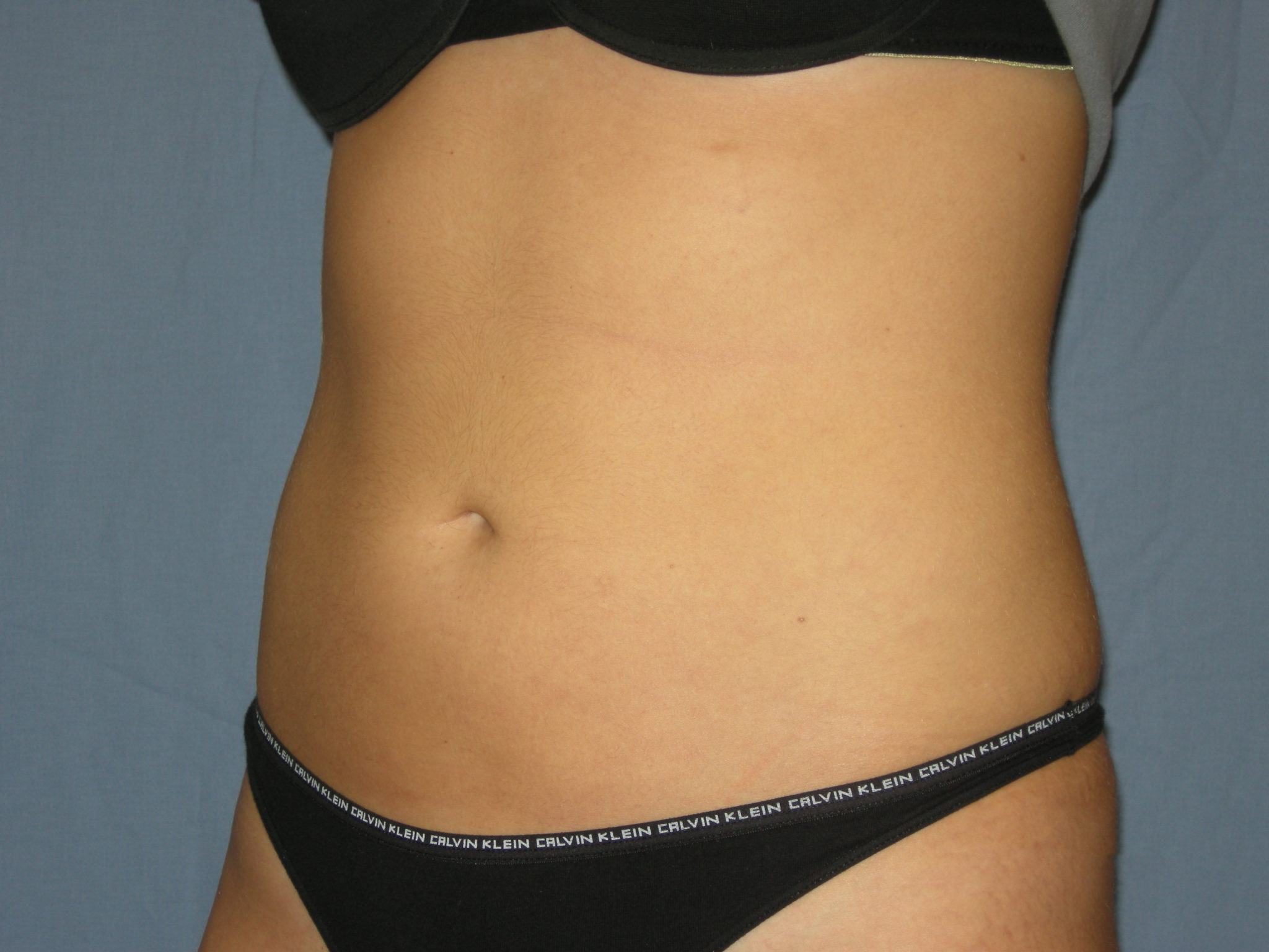 Liposuction Patient Photo - Case 3237 - after view-2