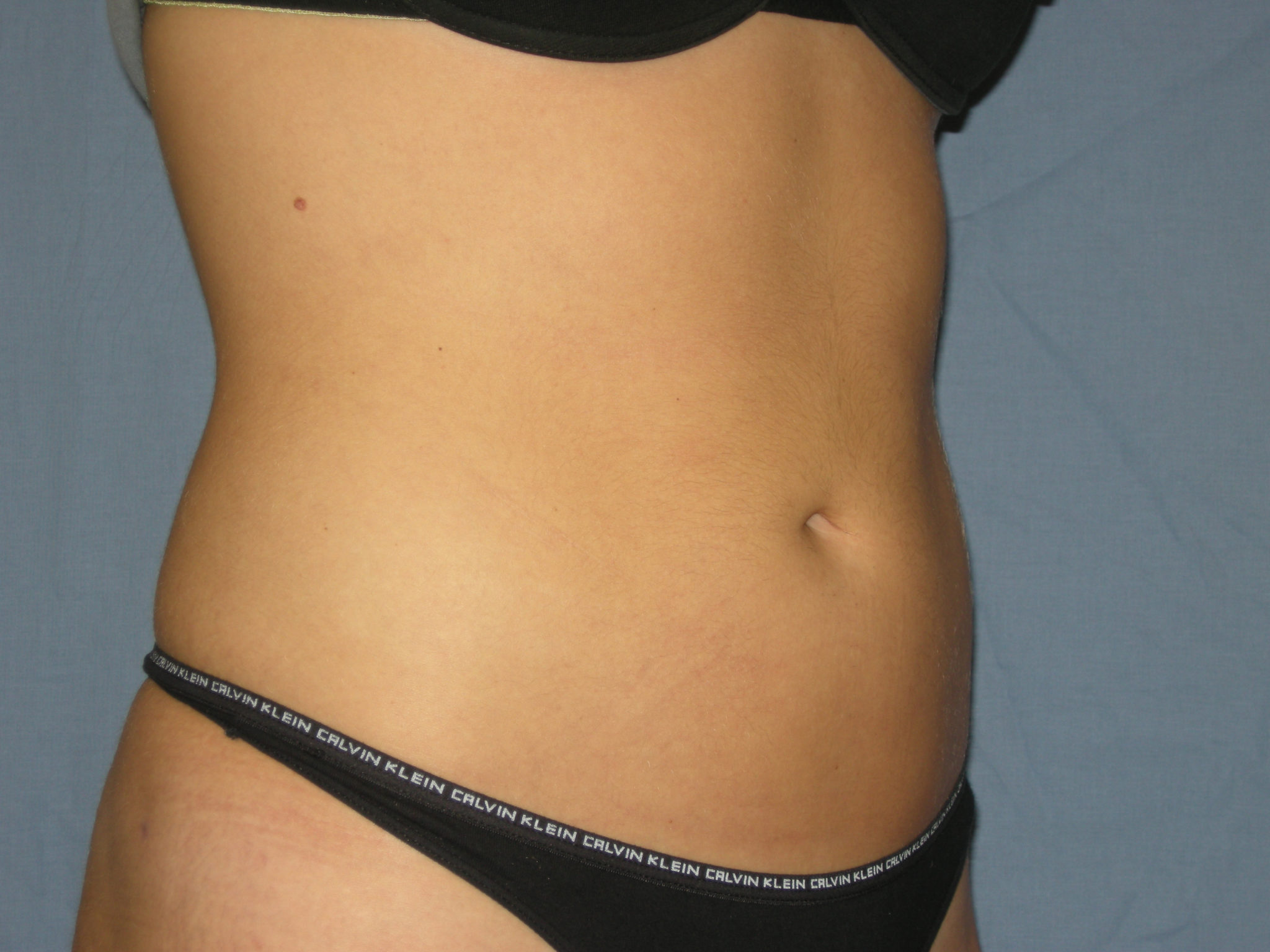 Liposuction Patient Photo - Case 3237 - after view-4