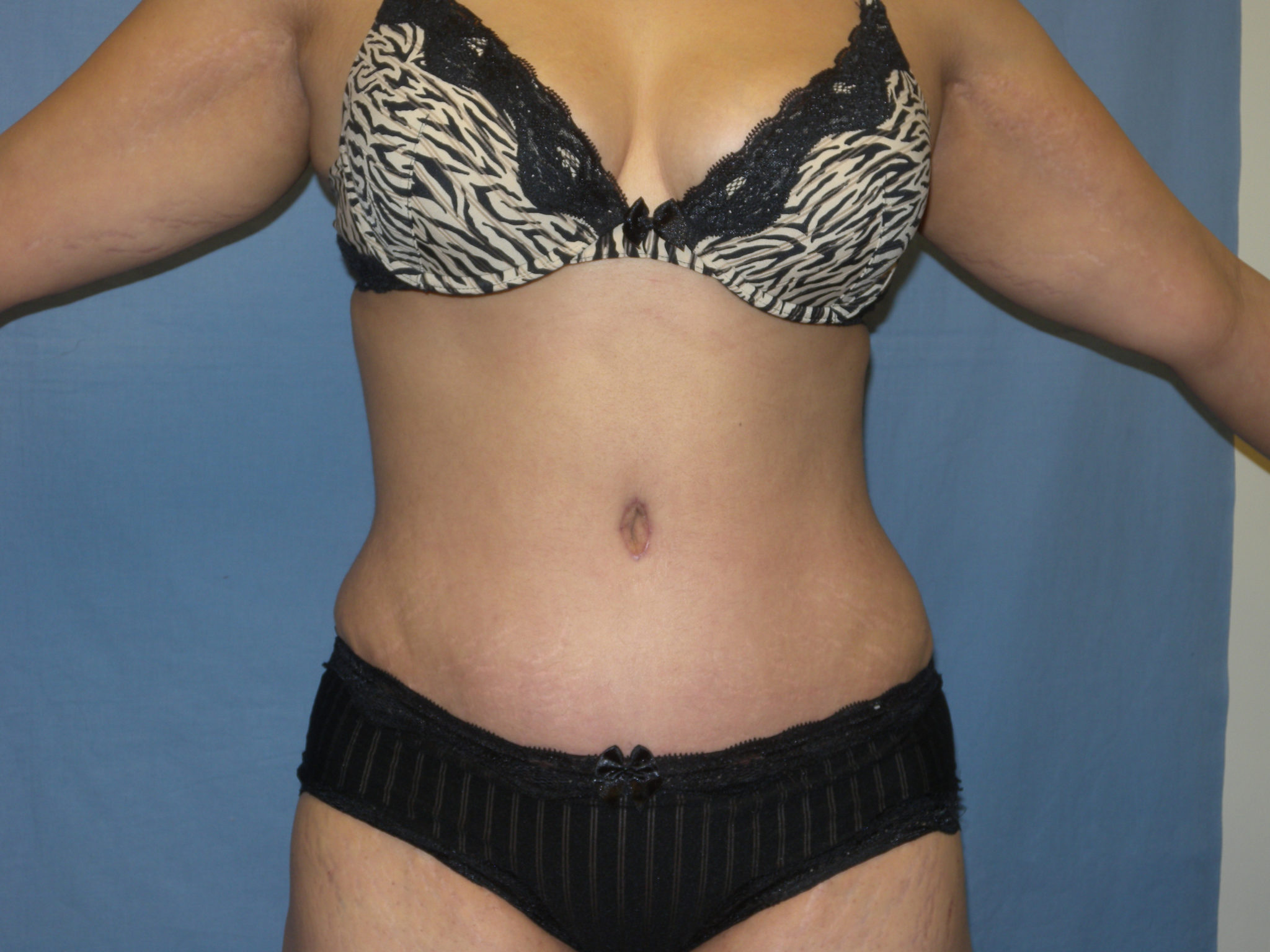 Tummy Tuck Patient Photo - Case 3422 - after view