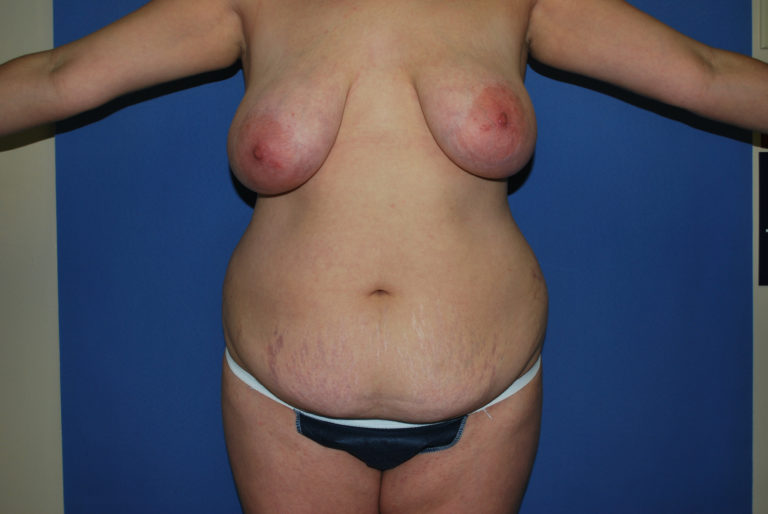 Tummy Tuck - Case 3321 - Before