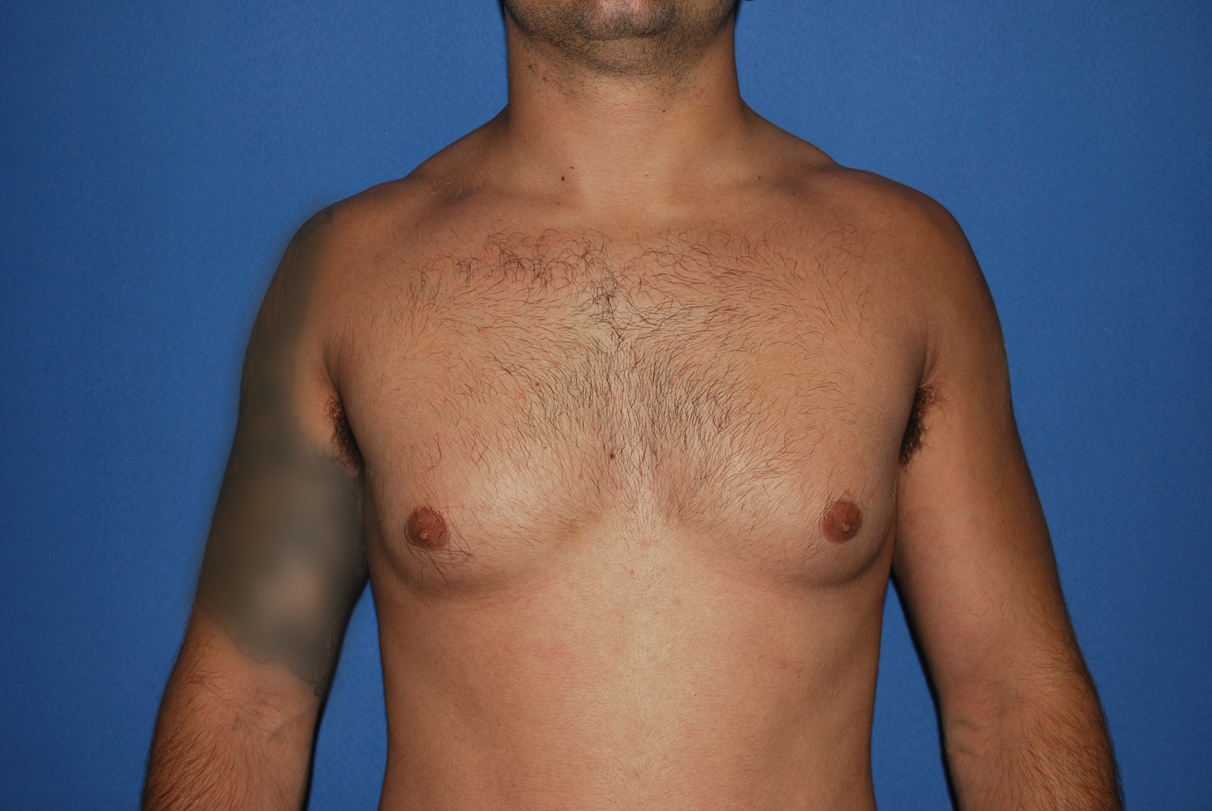 Male Breast Reduction Patient Photo - Case 5024 - before view-