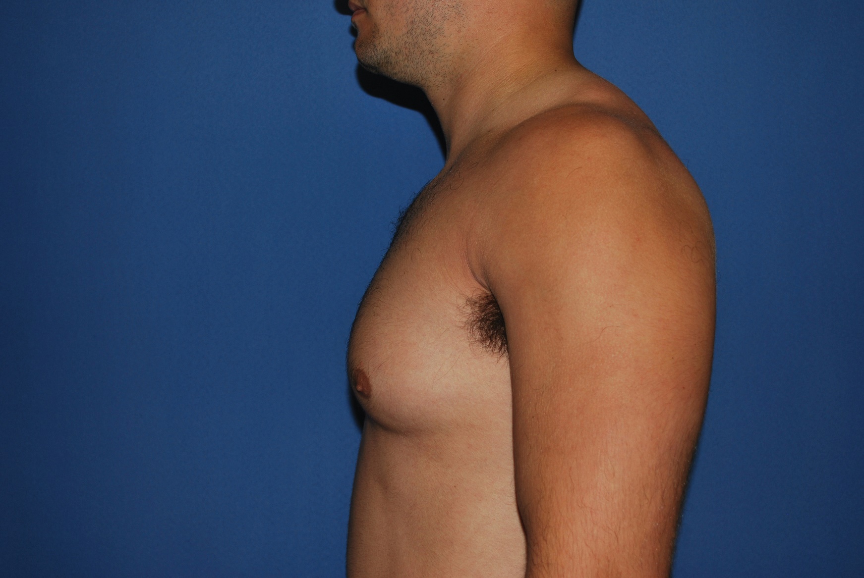 Male Breast Reduction Patient Photo - Case 5024 - before view-4