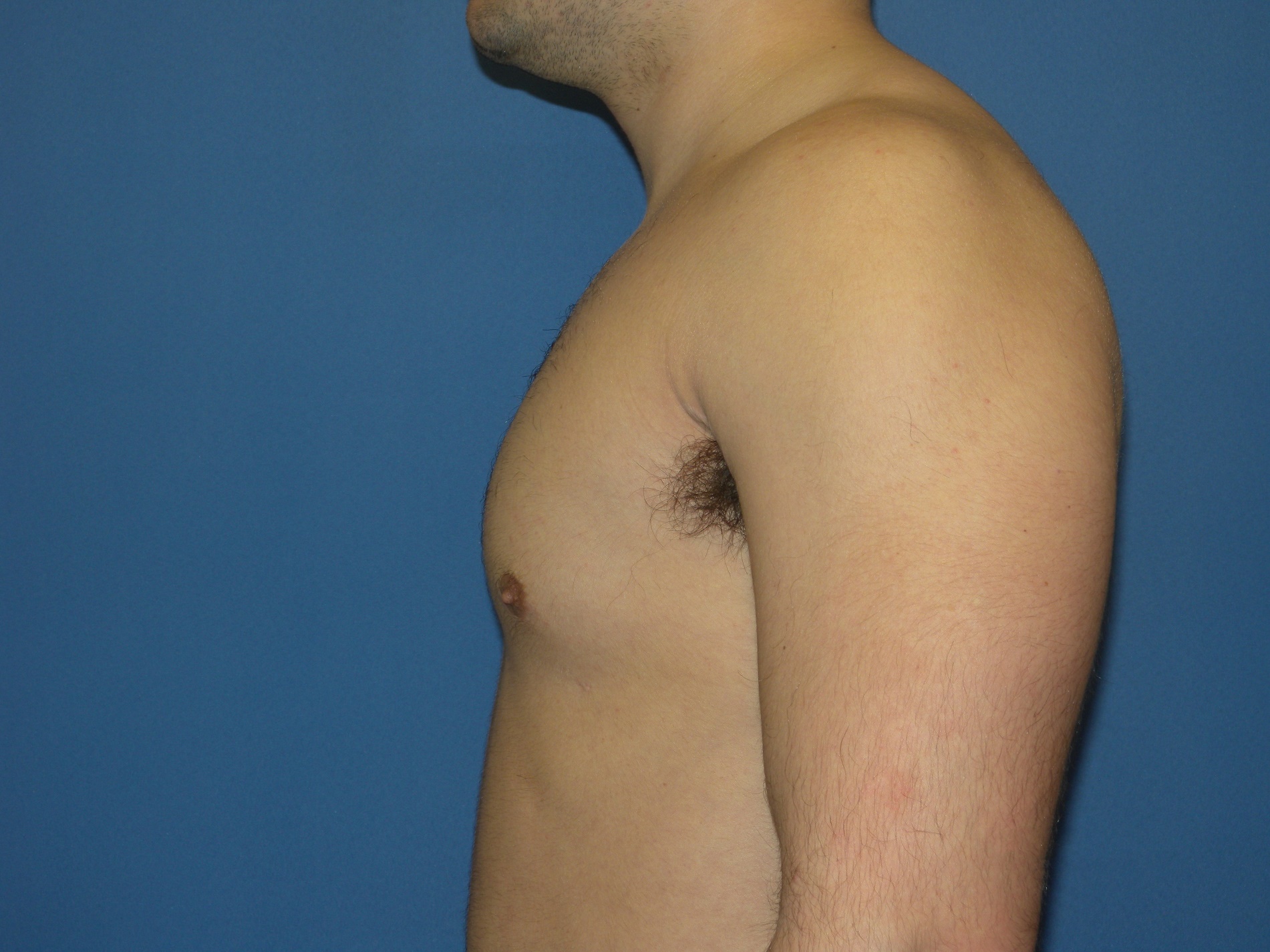 Male Breast Reduction Patient Photo - Case 5024 - after view-4