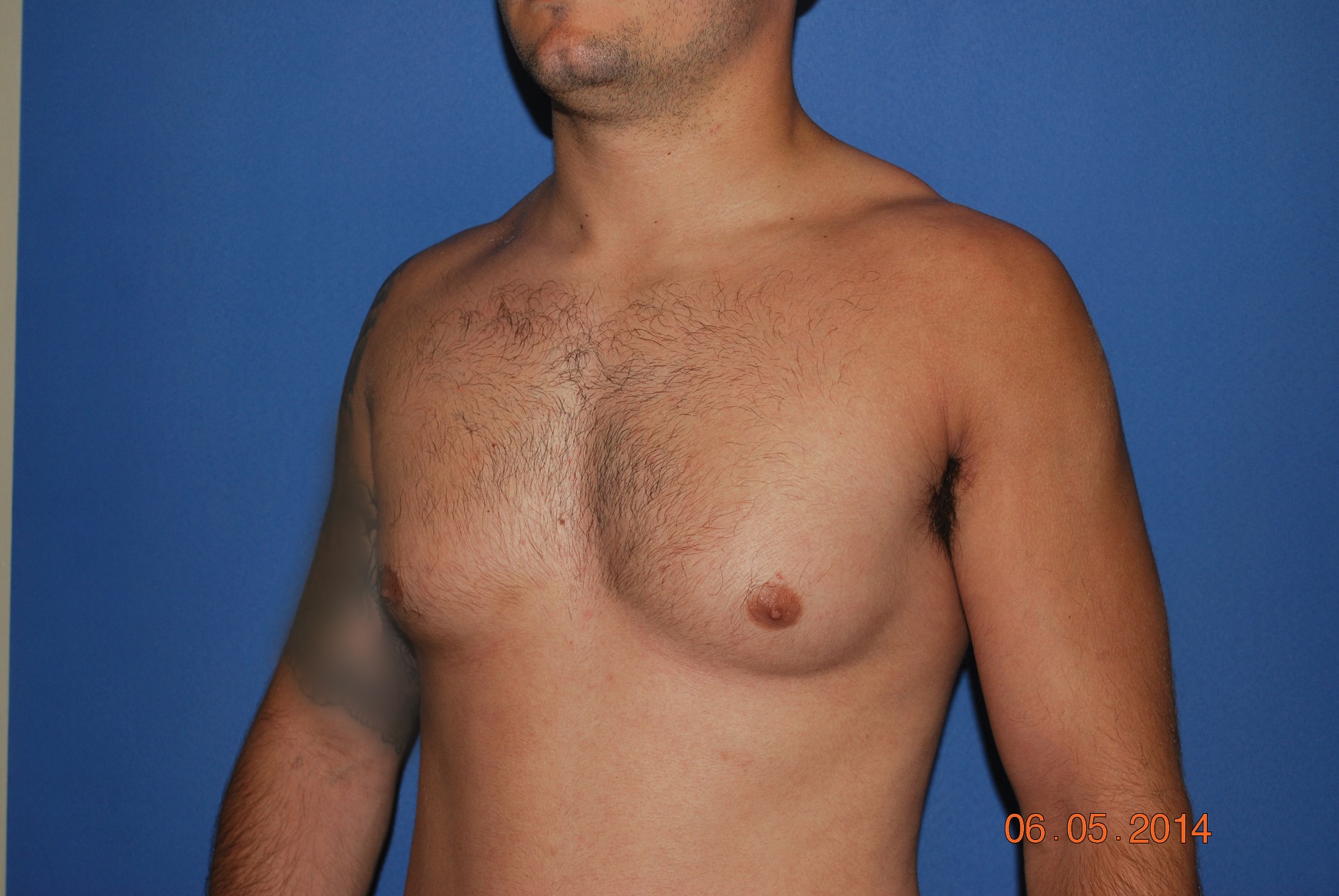 Male Breast Reduction Patient Photo - Case 5024 - before view-3