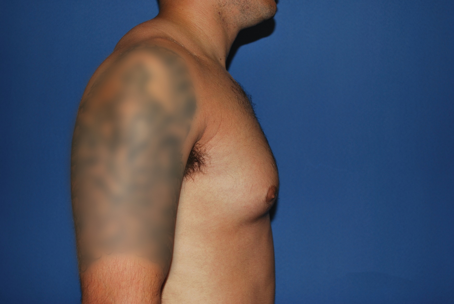 Male Breast Reduction Patient Photo - Case 5024 - before view-2