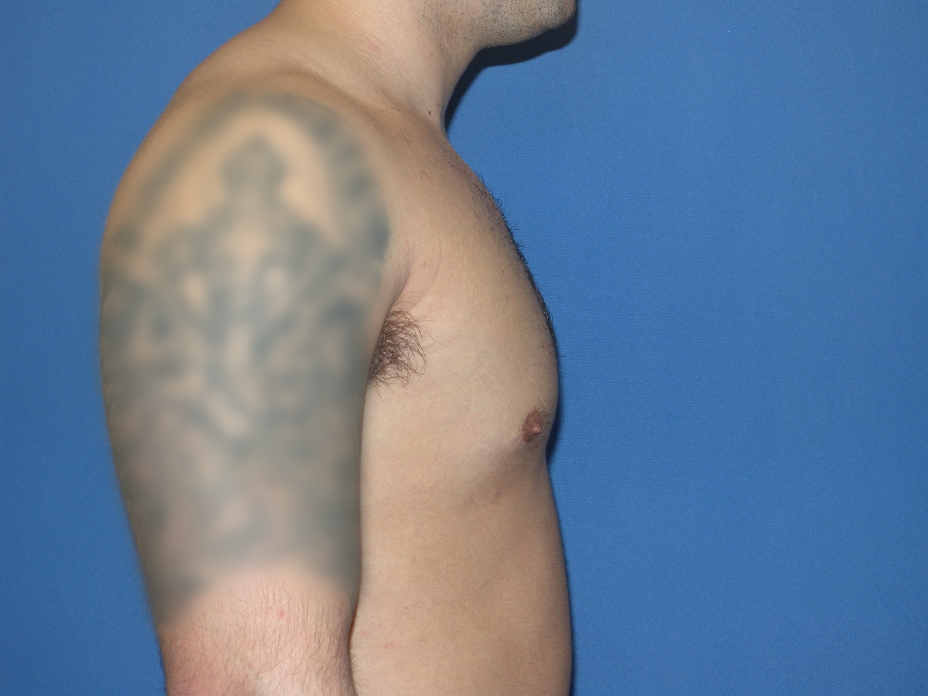 Male Breast Reduction Patient Photo - Case 5024 - after view-2