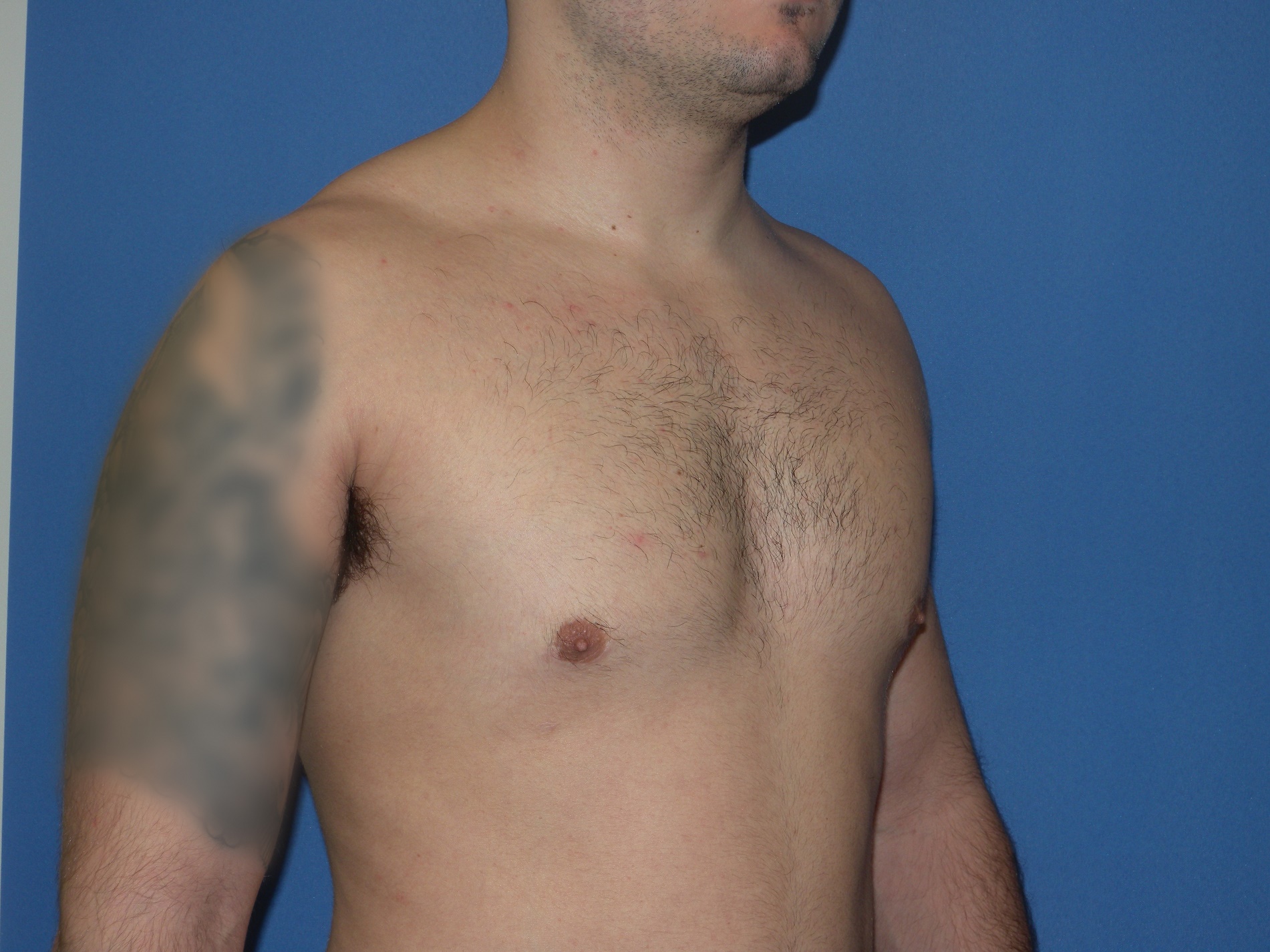 Male Breast Reduction Patient Photo - Case 5024 - after view-1