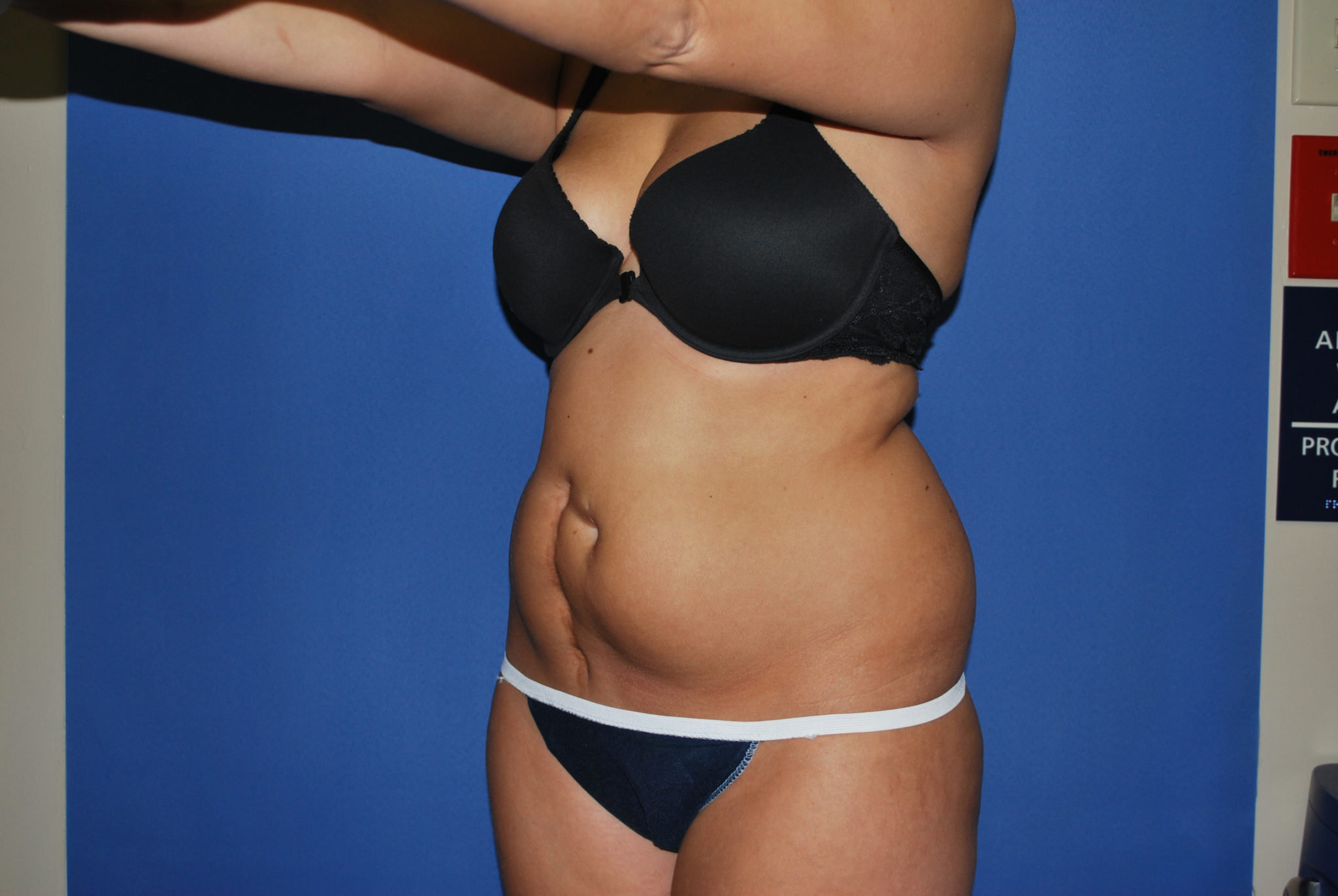 Liposuction Patient Photo - Case 3046 - before view-2