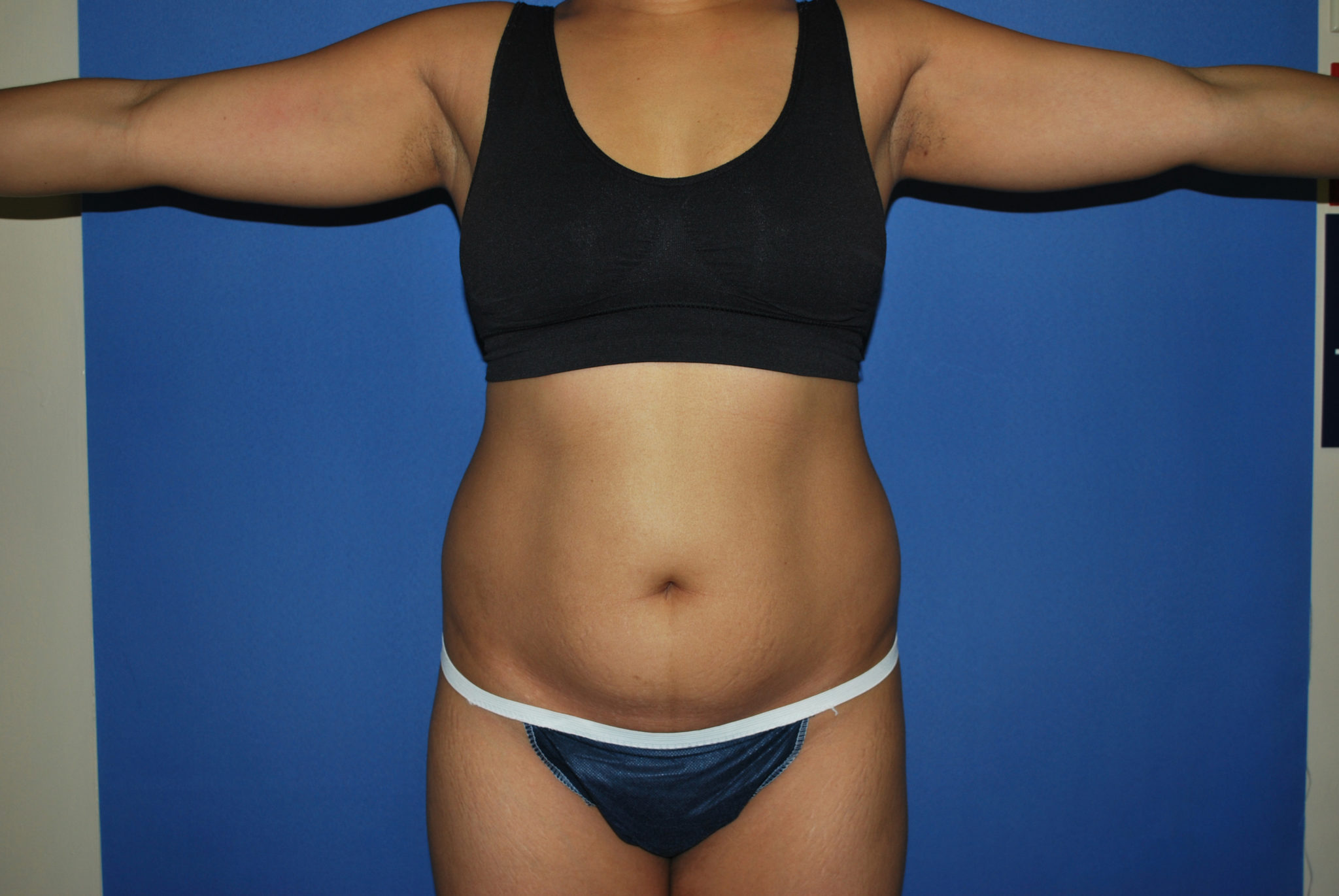 Liposuction Patient Photo - Case 3226 - before view-