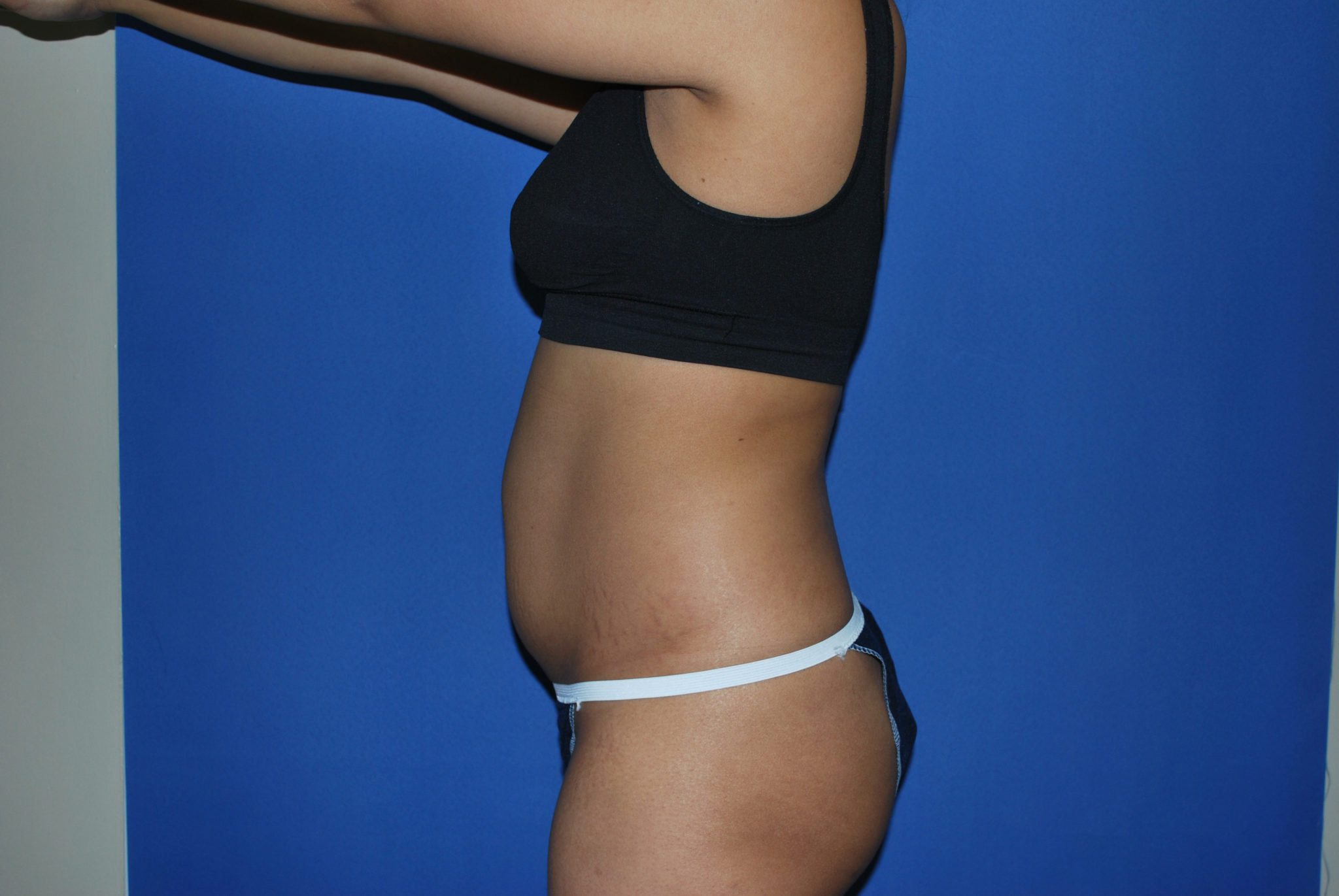 Liposuction Patient Photo - Case 3226 - before view-1