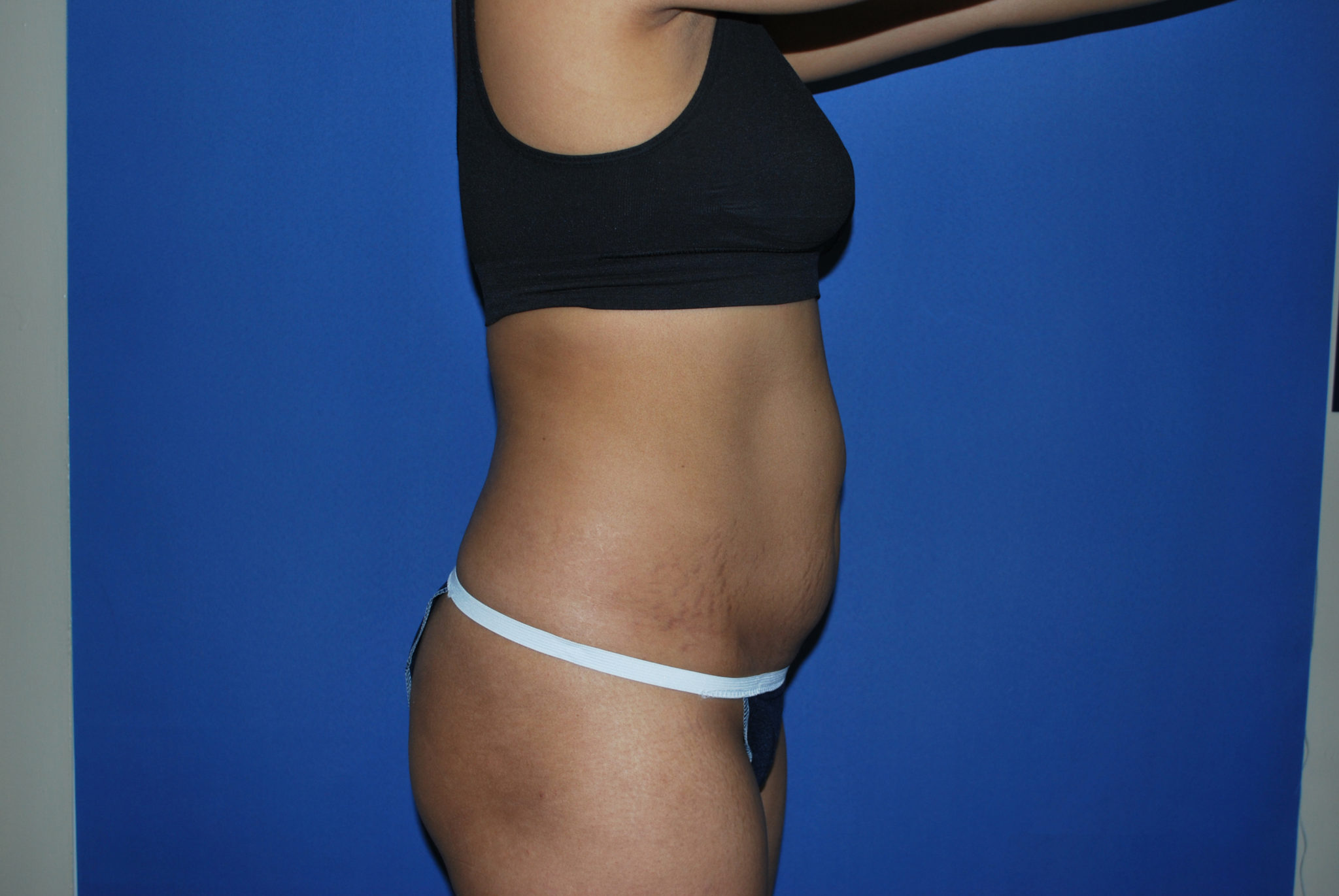 Liposuction Patient Photo - Case 3226 - before view-3