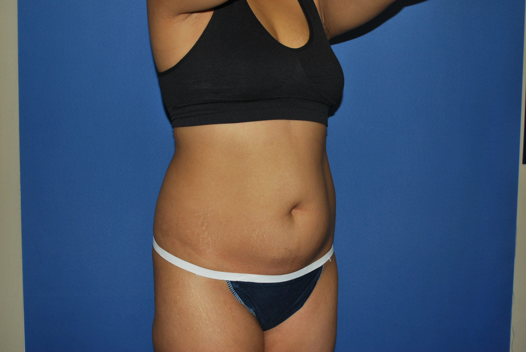 Liposuction Patient Photo - Case 3226 - before view-4