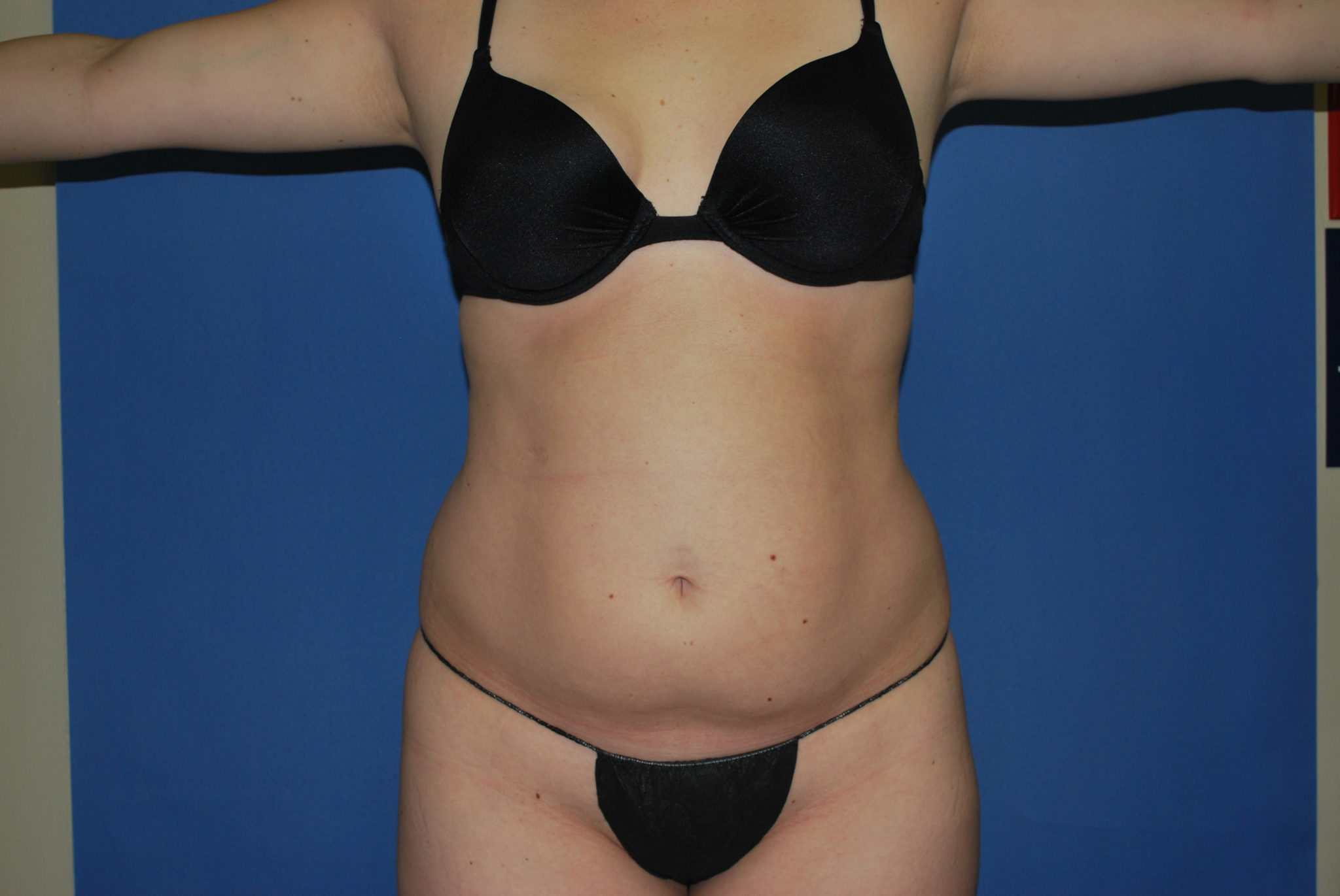 Liposuction Patient Photo - Case 3068 - before view-