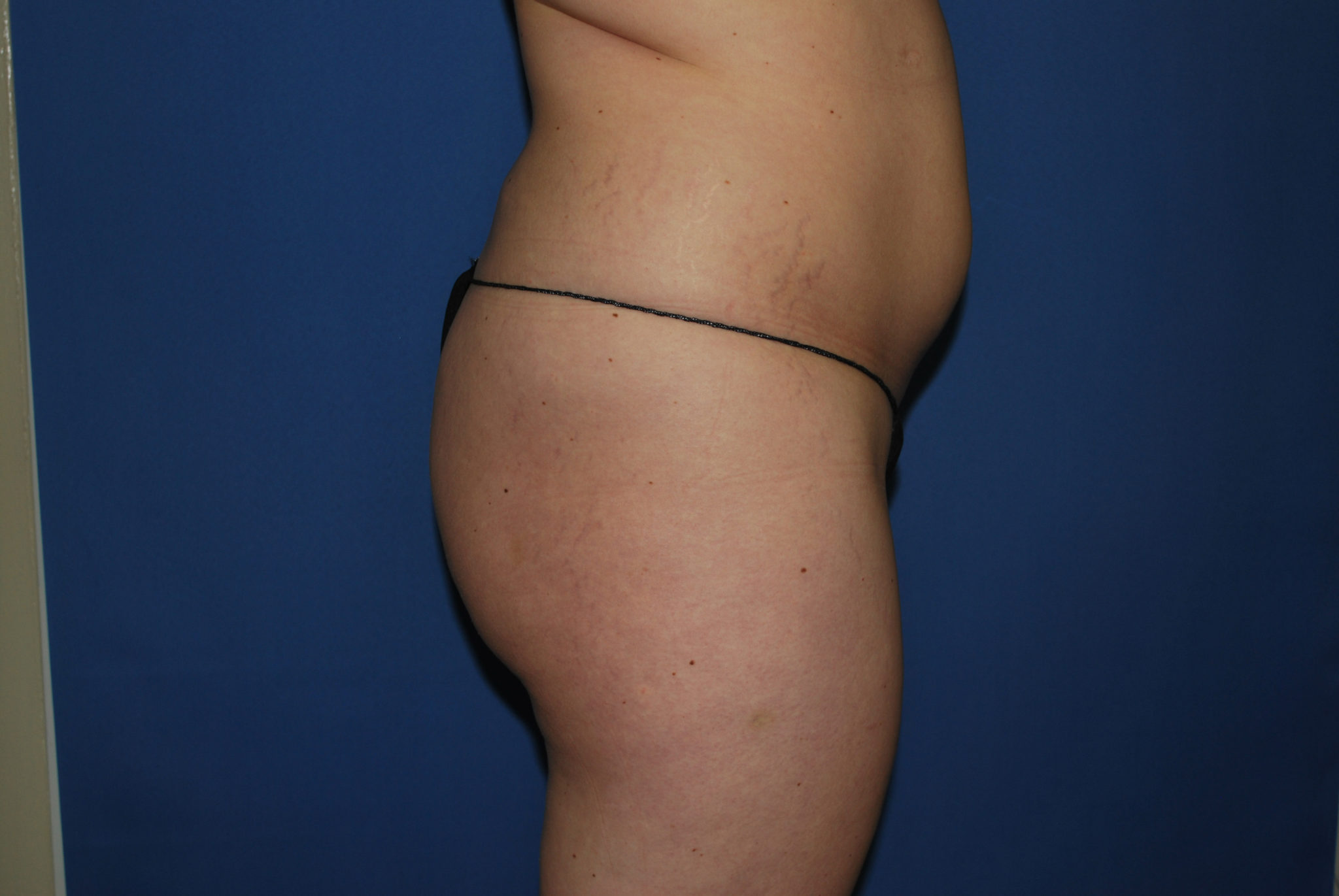 Liposuction Patient Photo - Case 3068 - before view-5