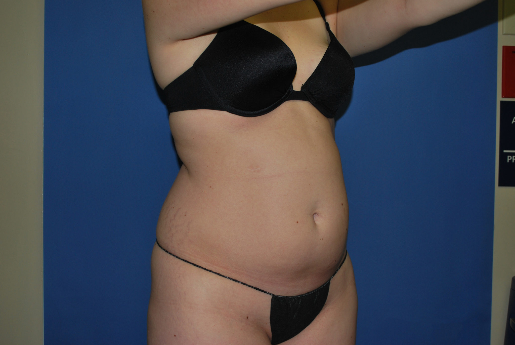 Liposuction Patient Photo - Case 3068 - before view-6