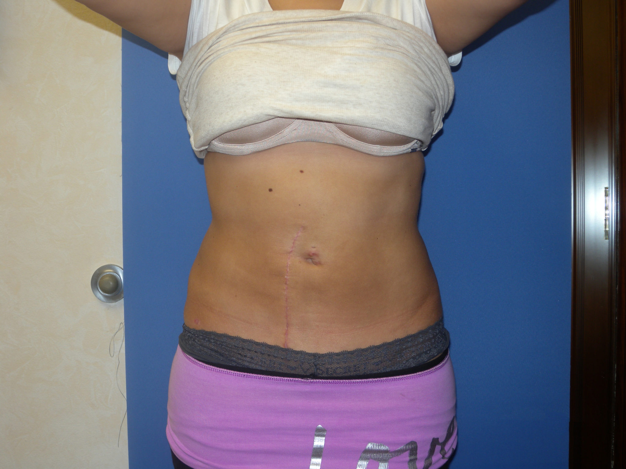 Liposuction Patient Photo - Case 3046 - after view