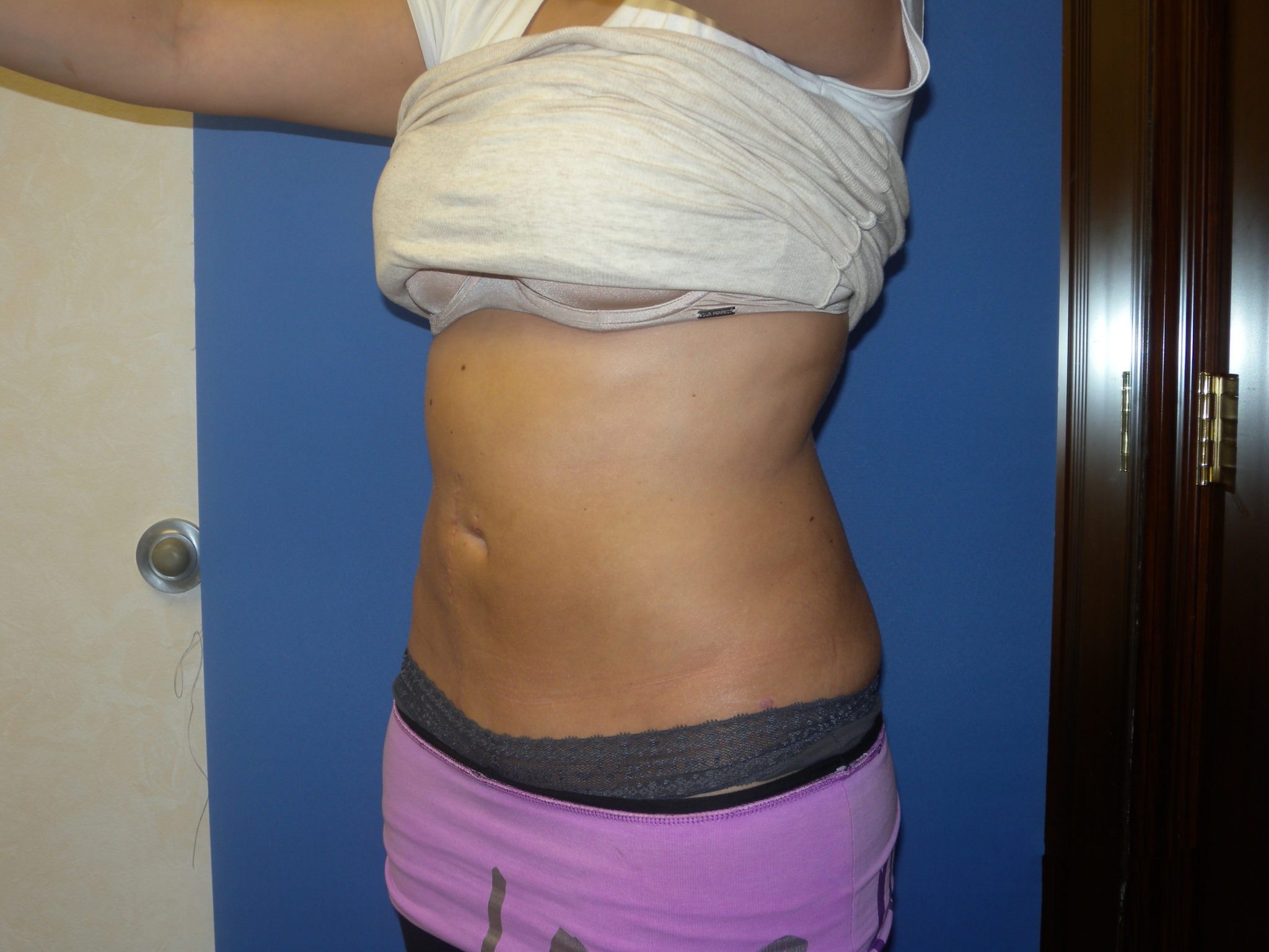 Liposuction Patient Photo - Case 3046 - after view-2