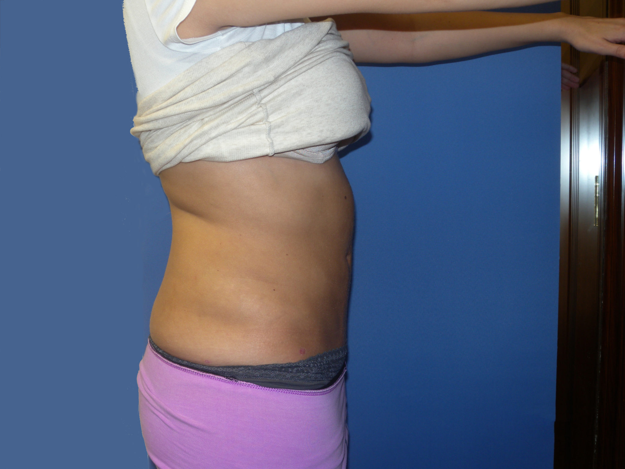 Liposuction Patient Photo - Case 3046 - after view-3