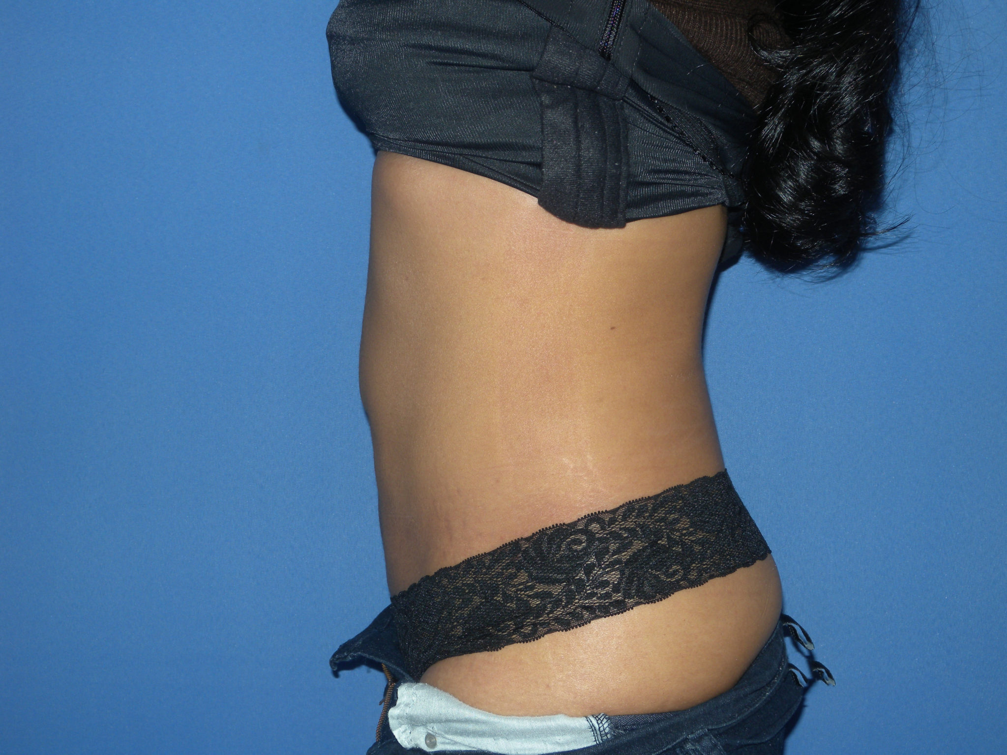 Liposuction Patient Photo - Case 3226 - after view-1