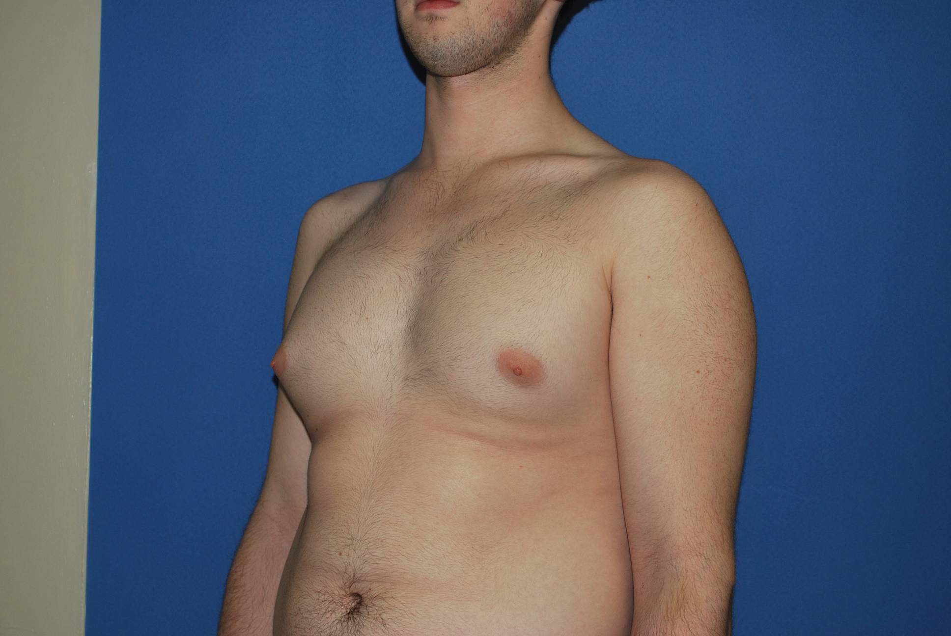 Male Breast Reduction Patient Photo - Case 4897 - before view-3