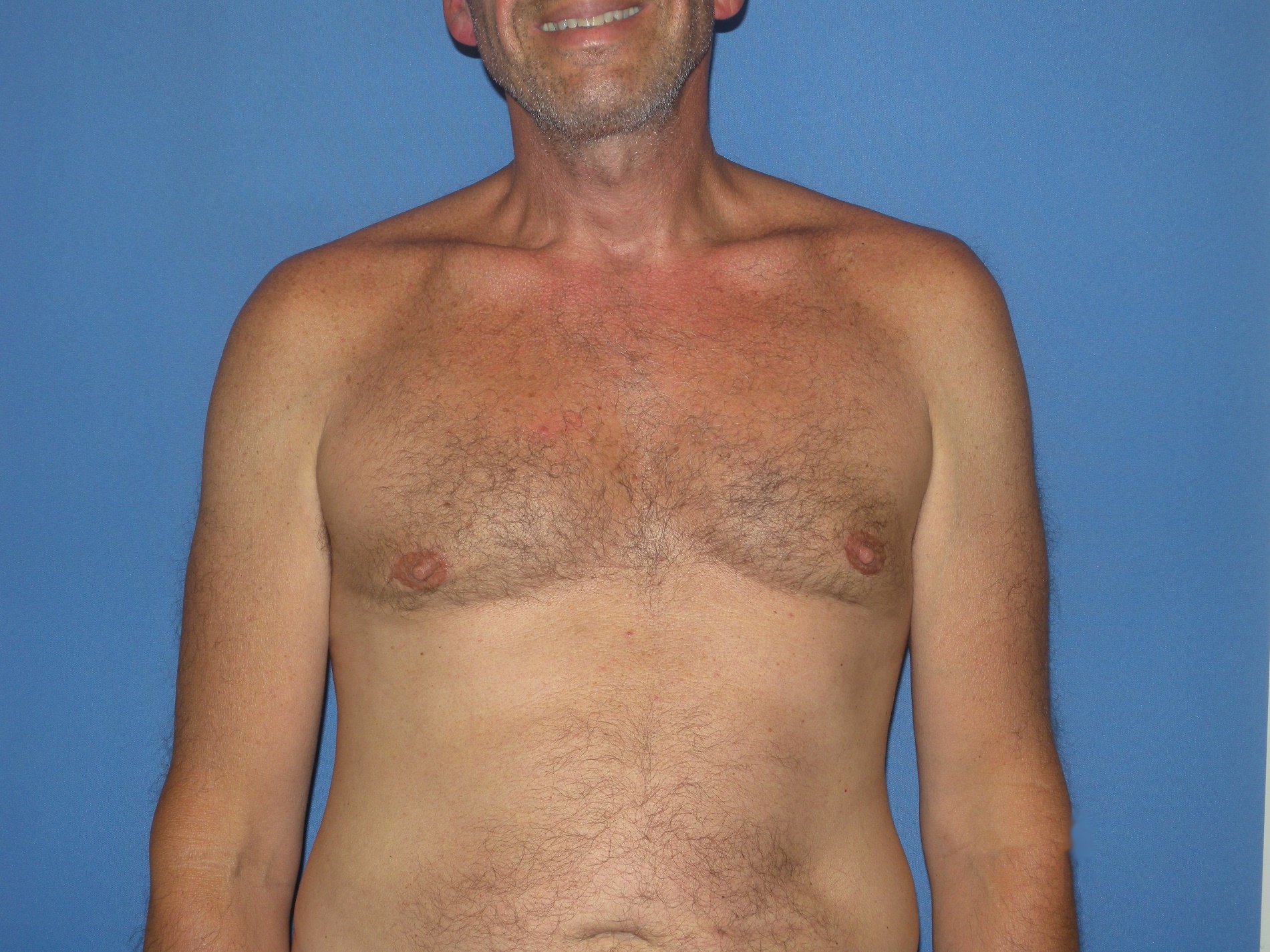 Male Breast Reduction Patient Photo - Case 4920 - after view