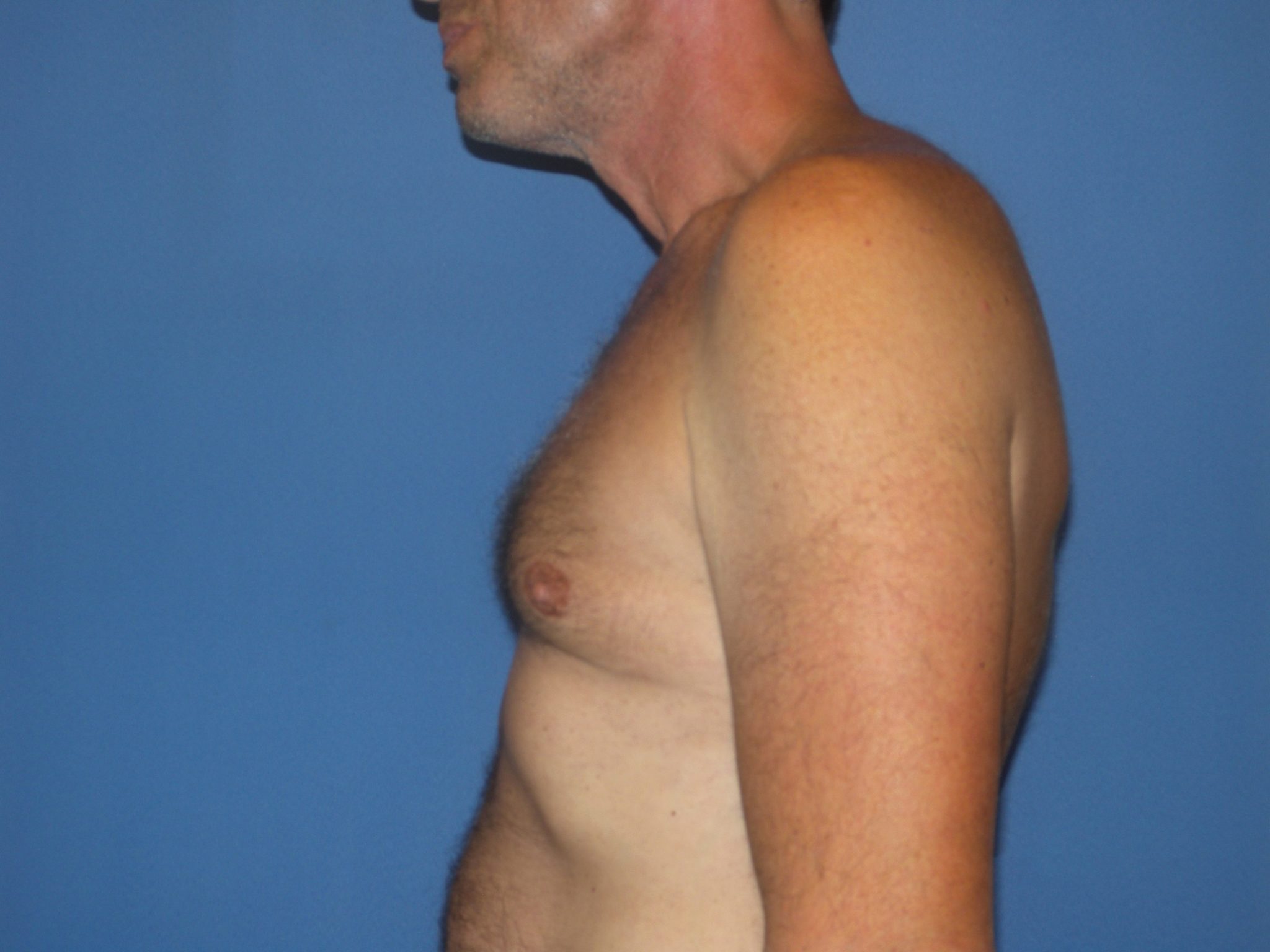 Male Breast Reduction Patient Photo - Case 4920 - after view-4