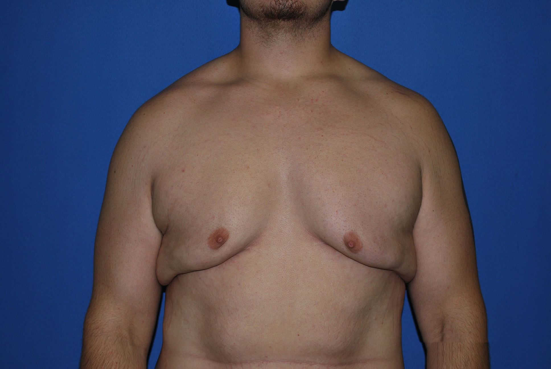 Male Breast Reduction Patient Photo - Case 4198 - before view-