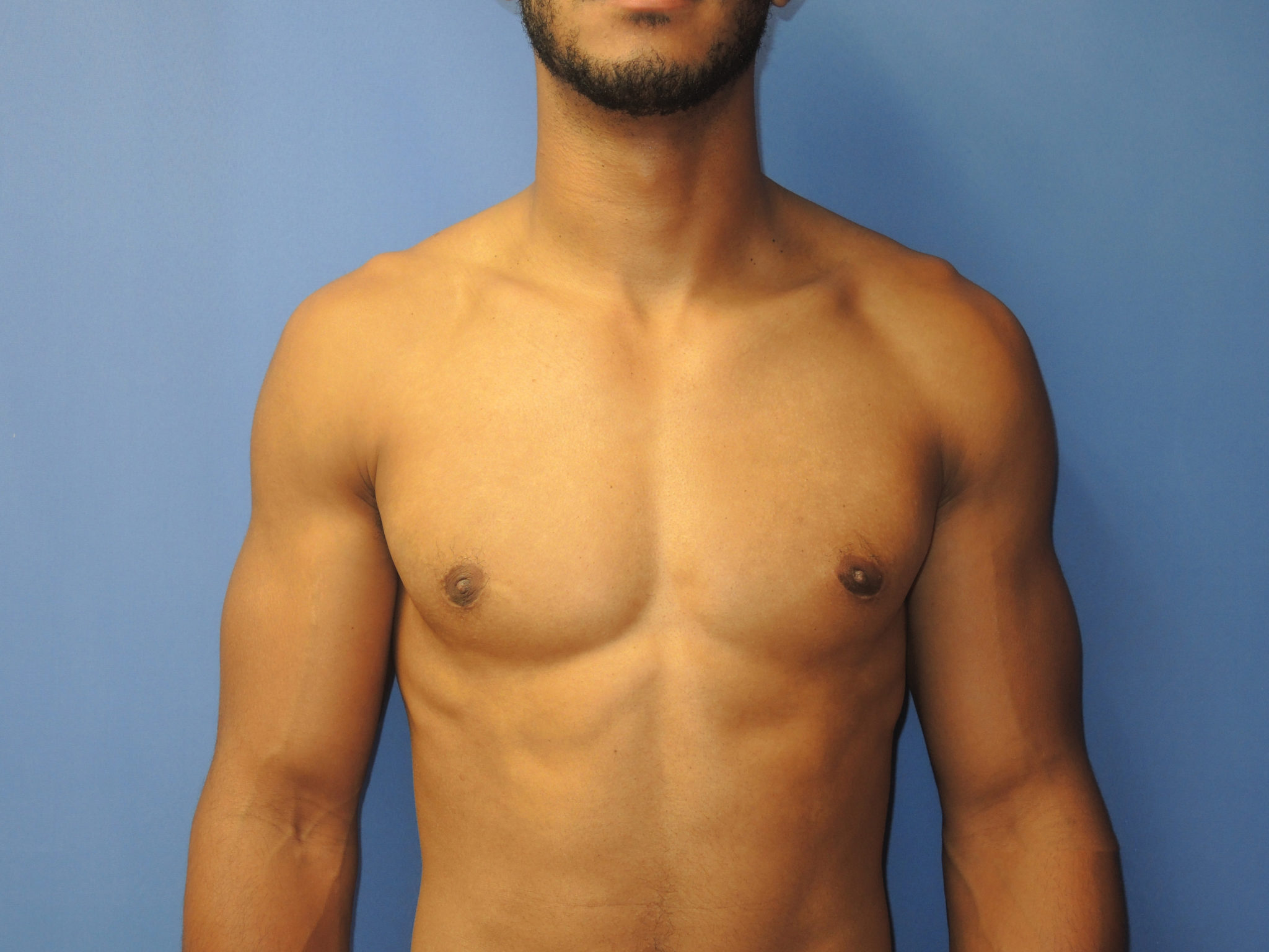 Male Breast Reduction Patient Photo - Case 5053 - after view