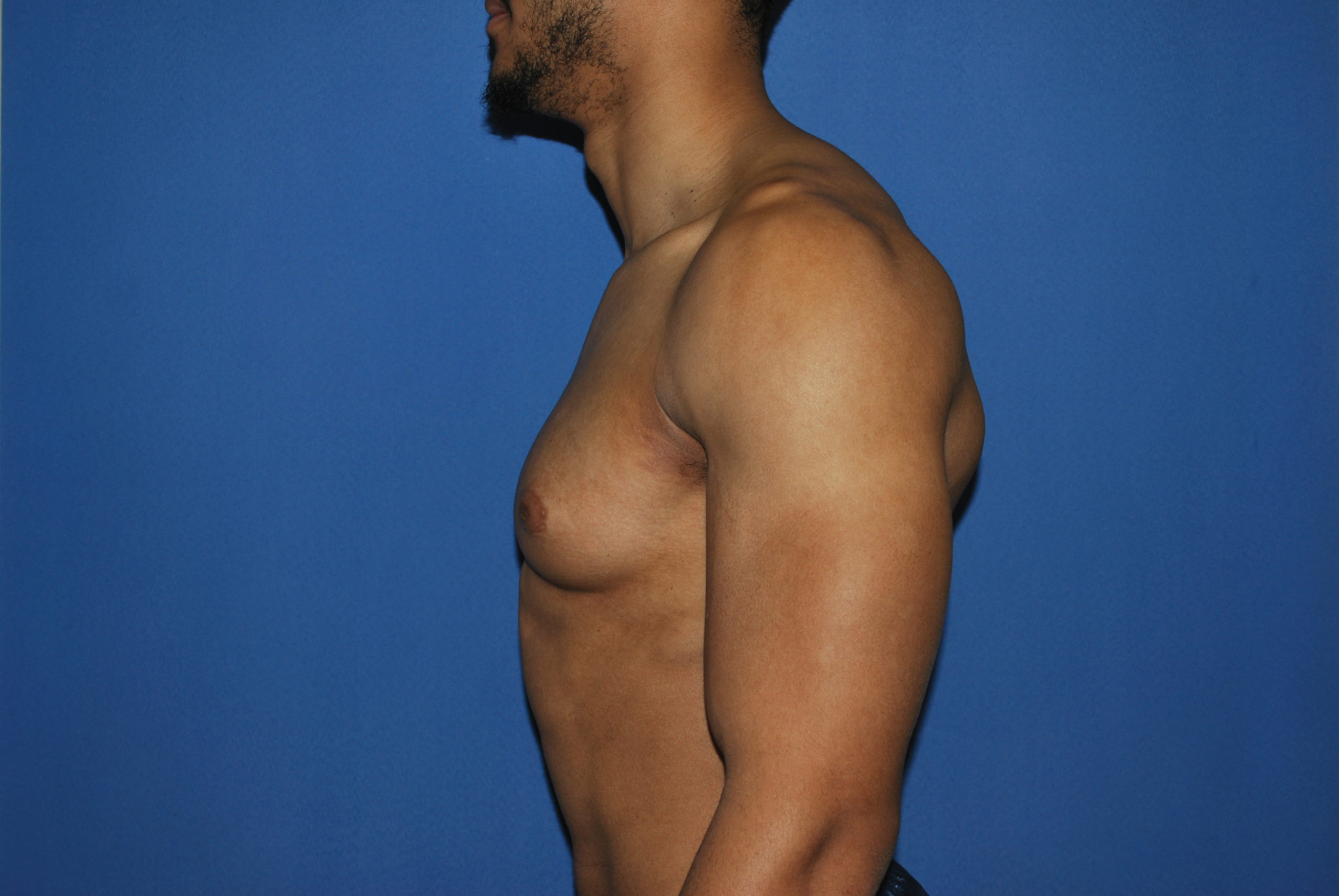 Male Breast Reduction Patient Photo - Case 5053 - before view-4