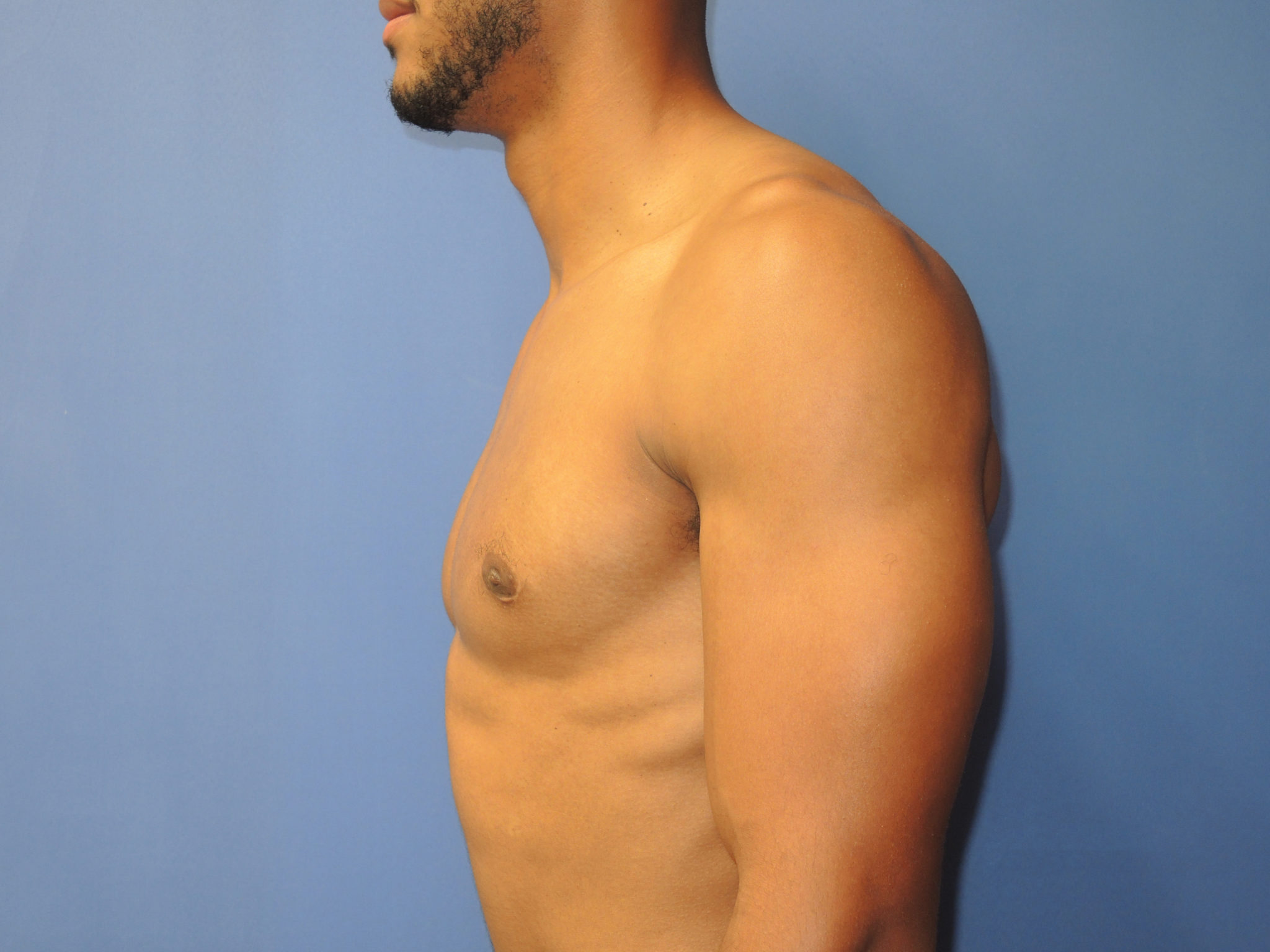 Male Breast Reduction Patient Photo - Case 5053 - after view-4