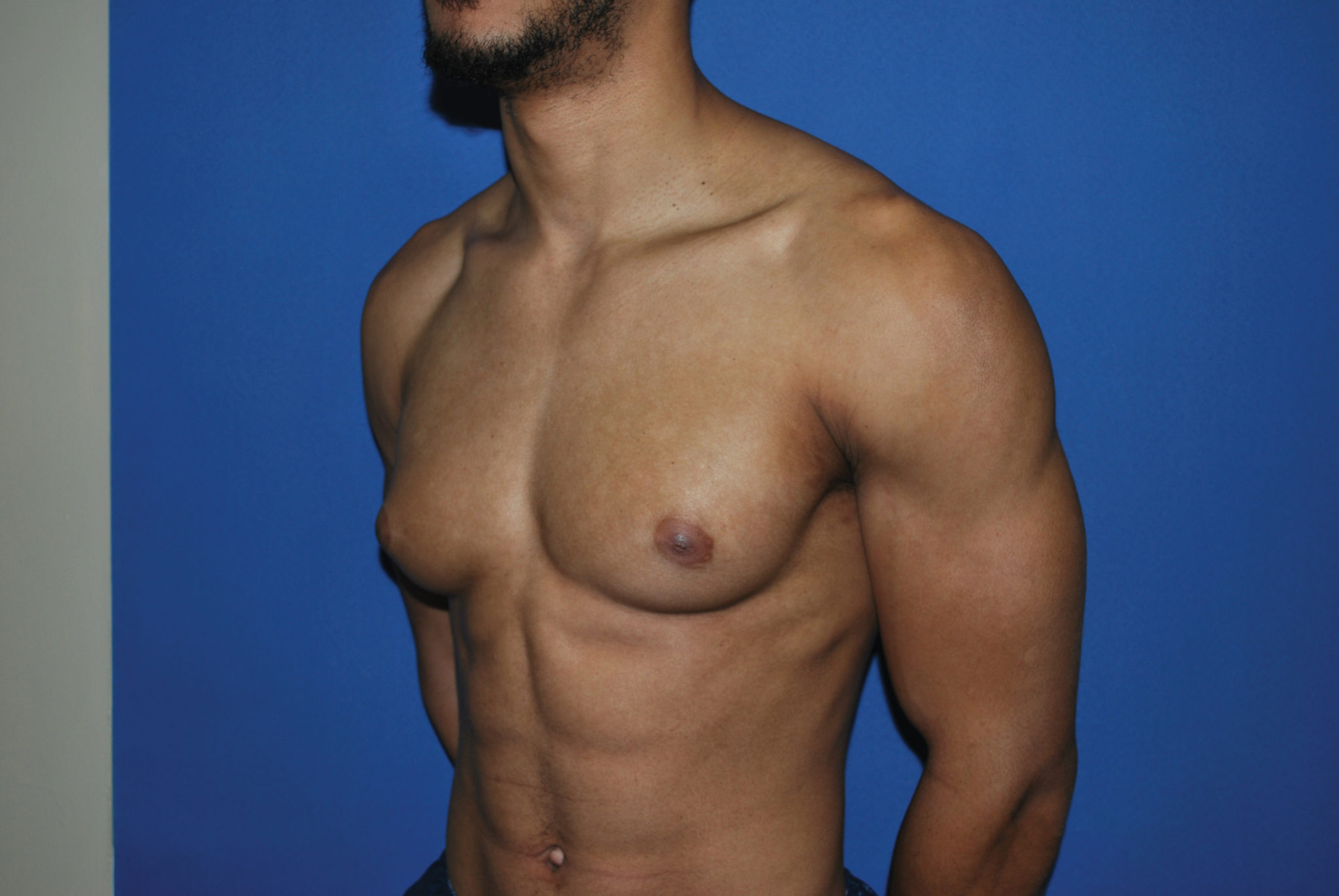 Male Breast Reduction Patient Photo - Case 5053 - before view-3