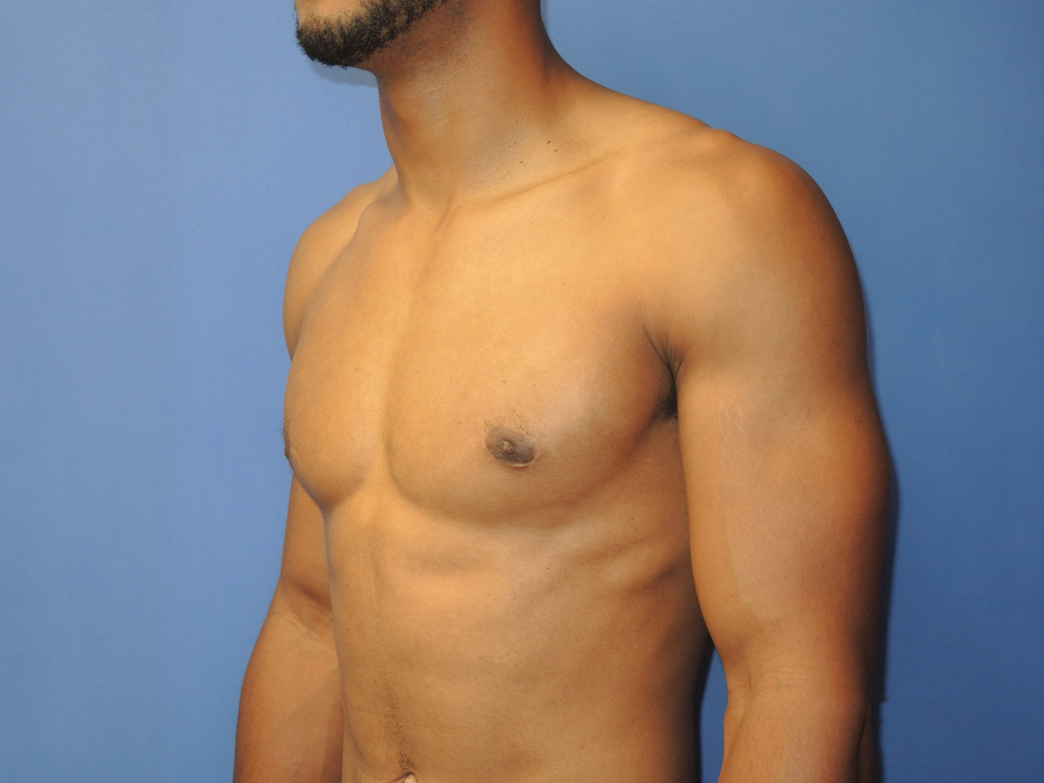 Male Breast Reduction Patient Photo - Case 5053 - after view-3