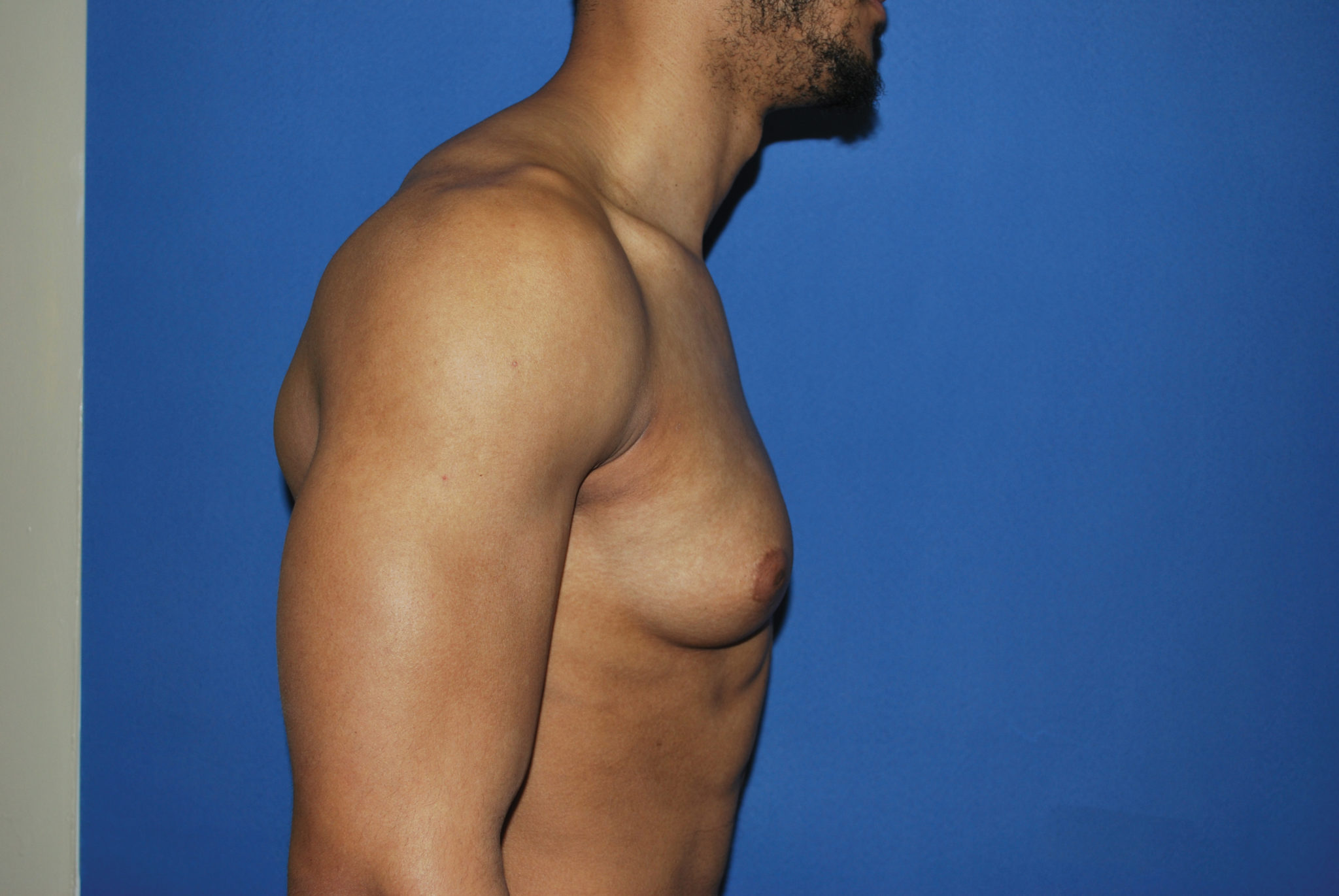 Male Breast Reduction Patient Photo - Case 5053 - before view-2