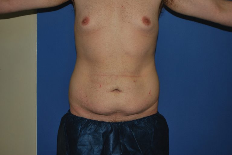 Tummy Tuck - Case 4204 - Before