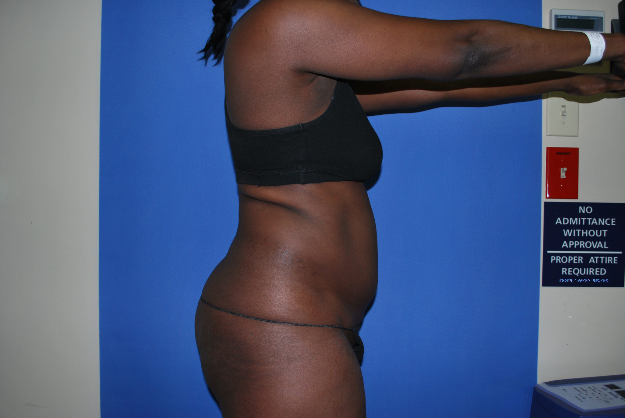 Liposuction Patient Photo - Case 3266 - before view-3