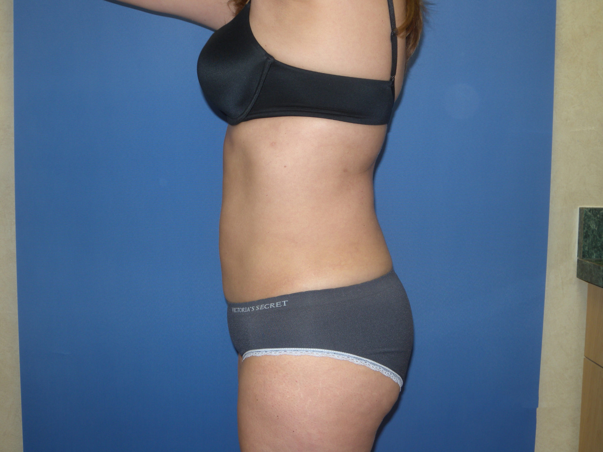 Liposuction Patient Photo - Case 3259 - after view-4