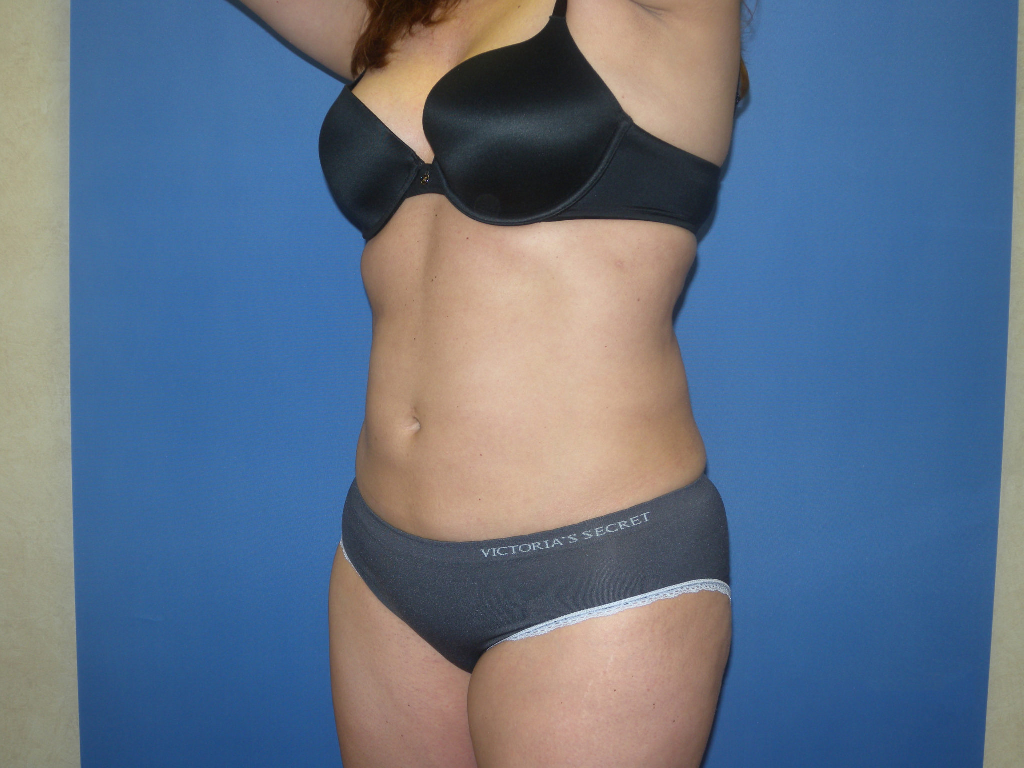 Liposuction Patient Photo - Case 3259 - after view-3