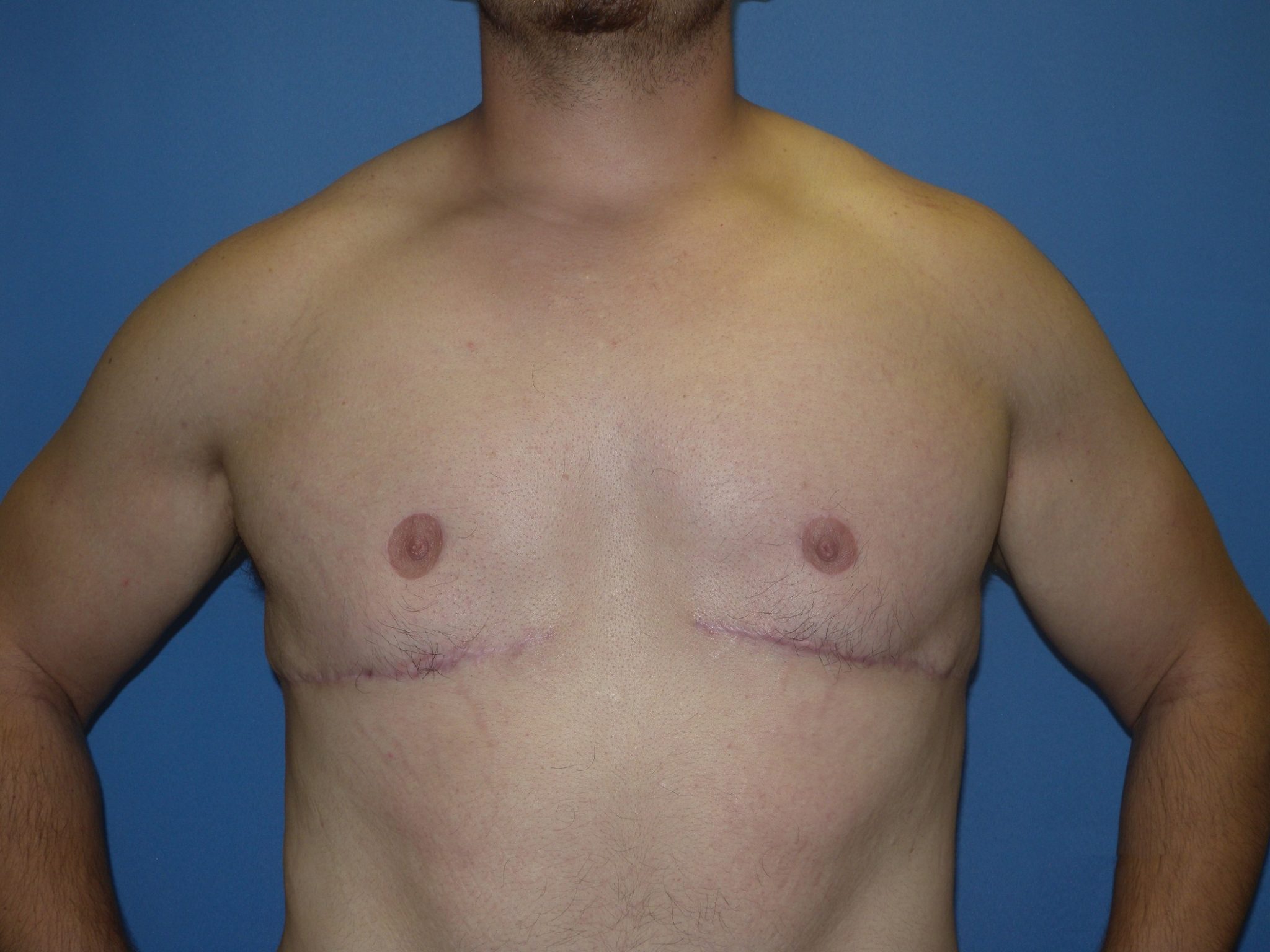 Male Breast Reduction Patient Photo - Case 4198 - after view