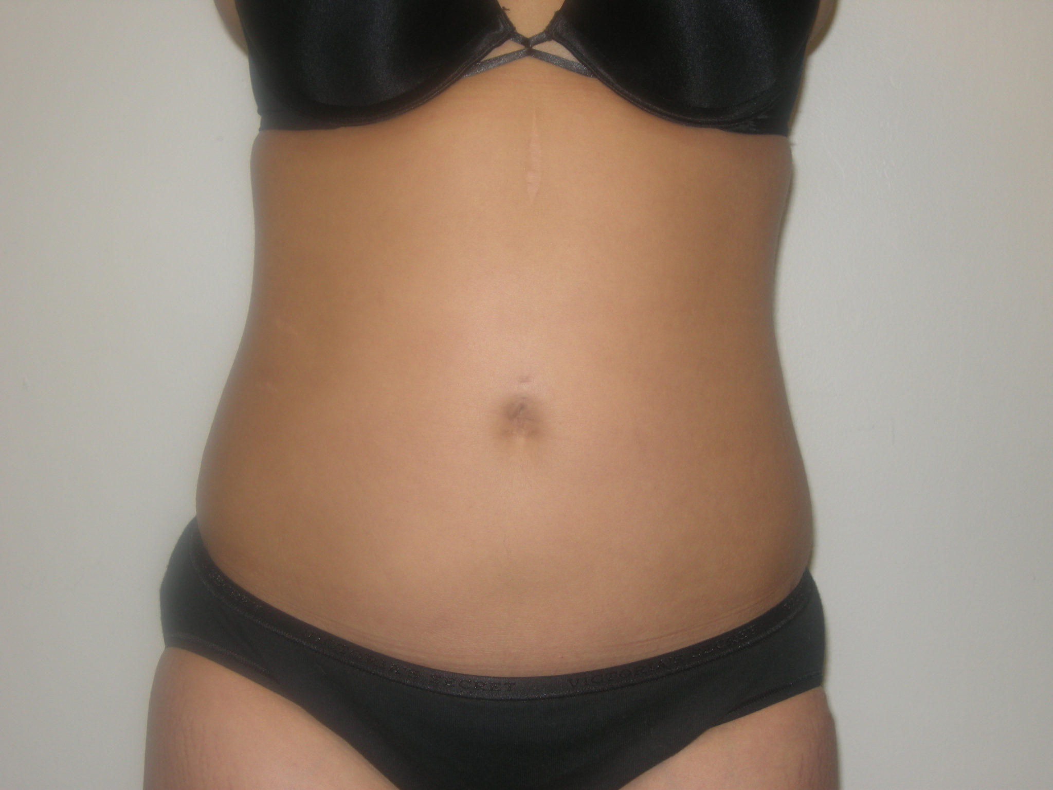 Liposuction Patient Photo - Case 3058 - after view