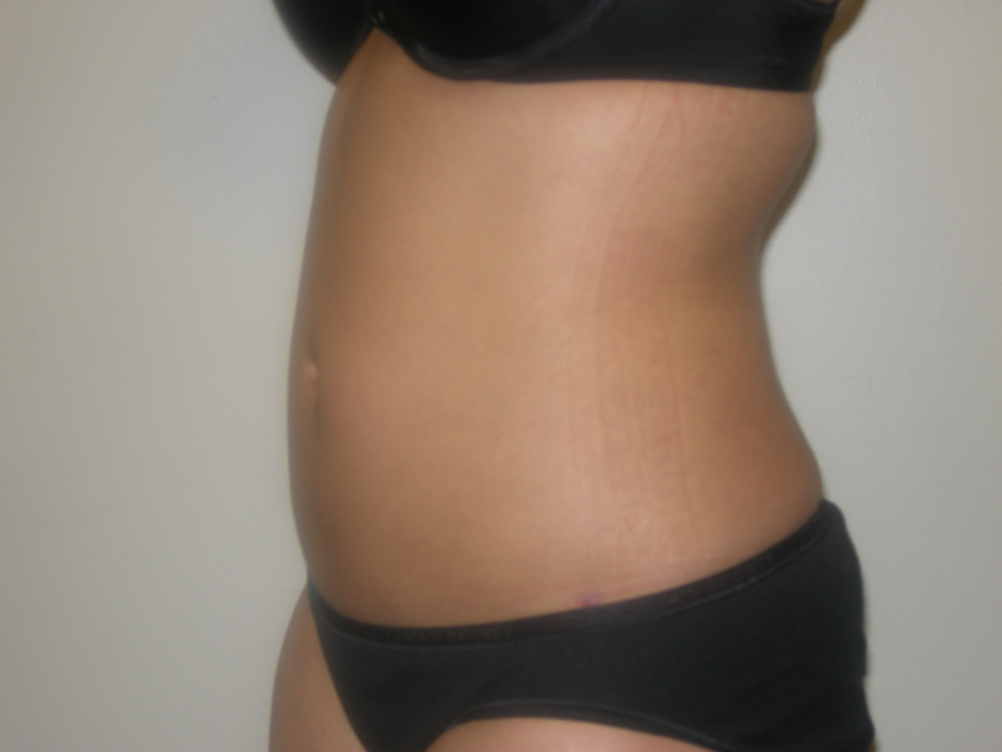 Liposuction Patient Photo - Case 3058 - after view-1