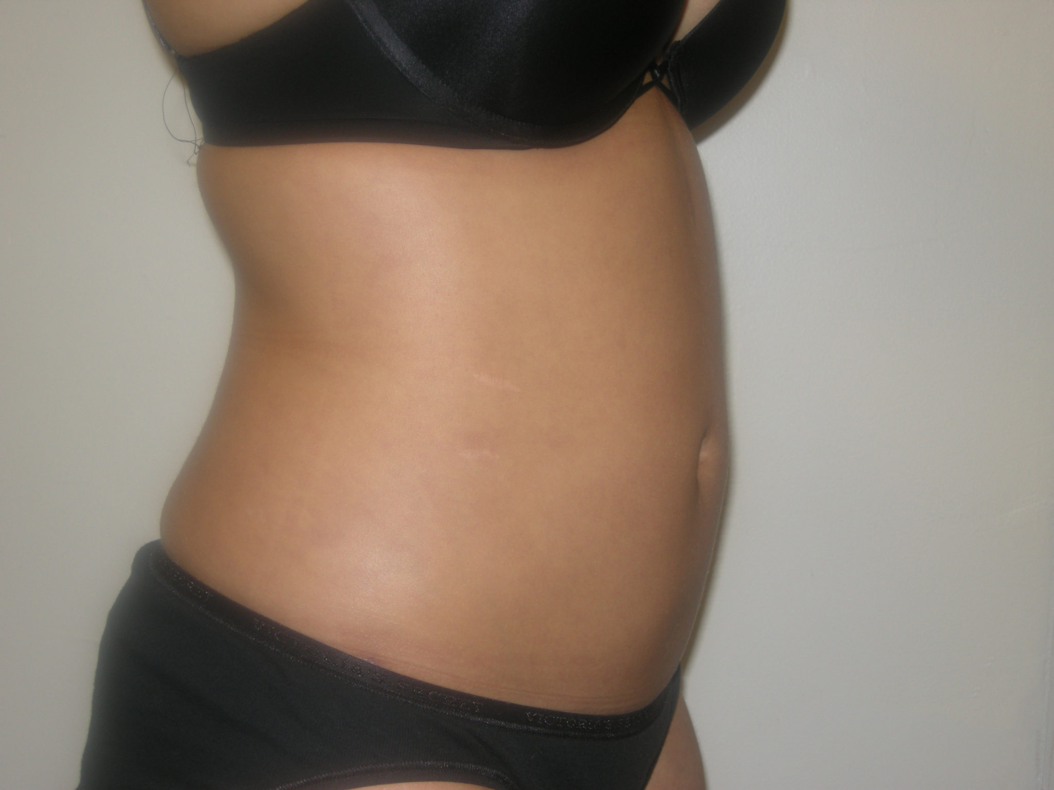 Liposuction Patient Photo - Case 3058 - after view-2