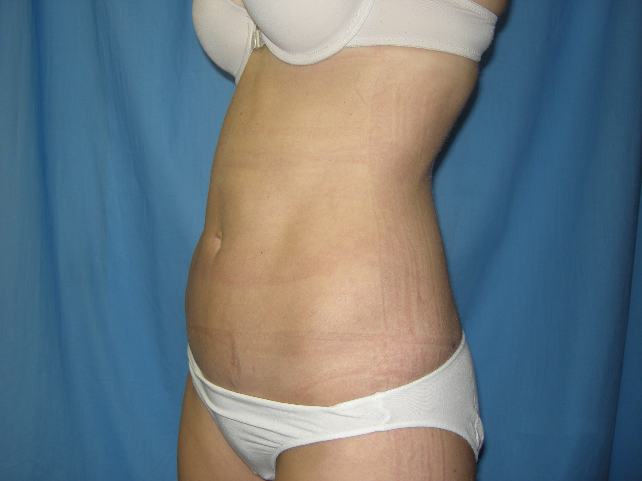 Liposuction Patient Photo - Case 3348 - after view-1