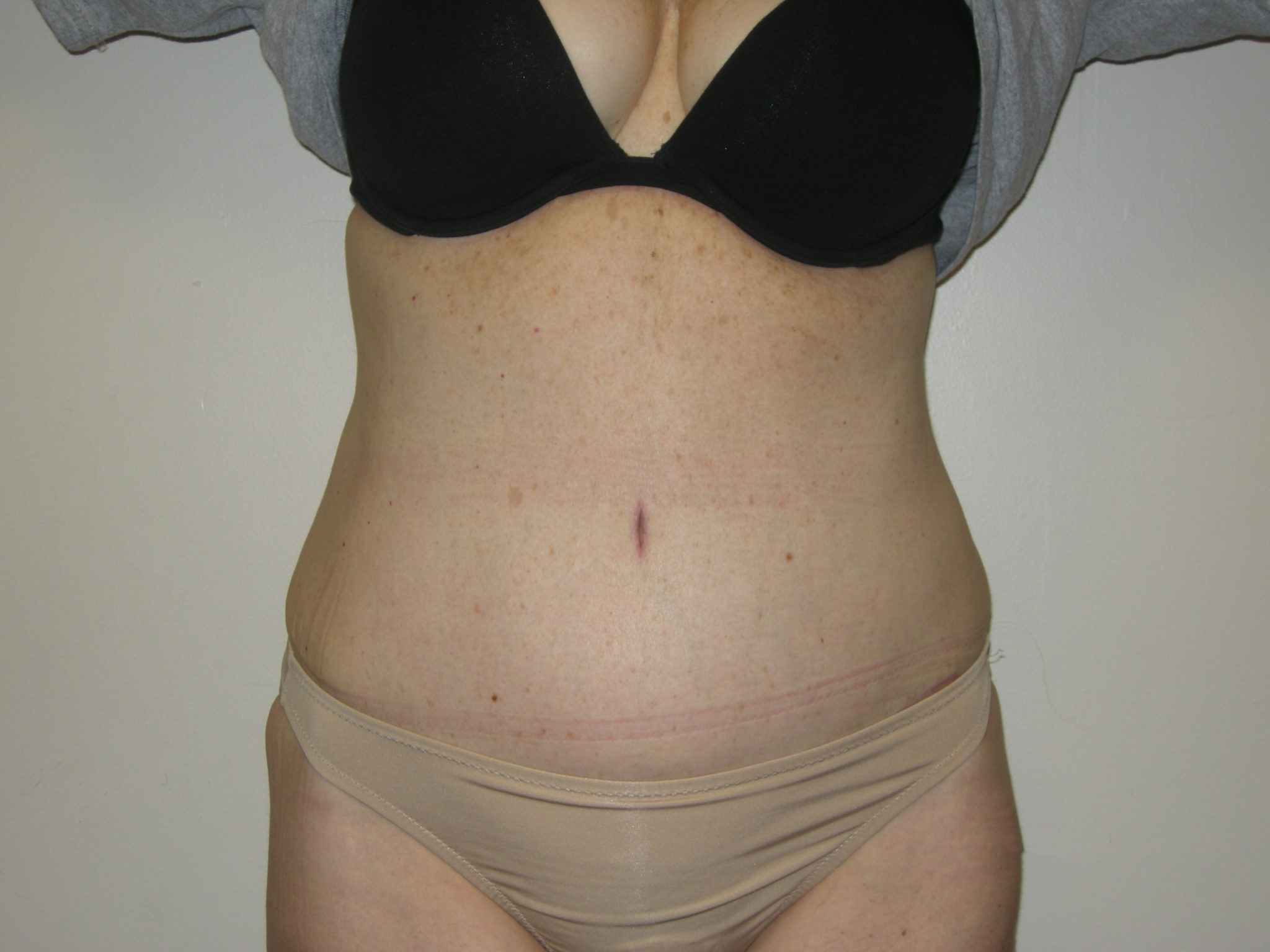 Tummy Tuck Patient Photo - Case 3454 - after view