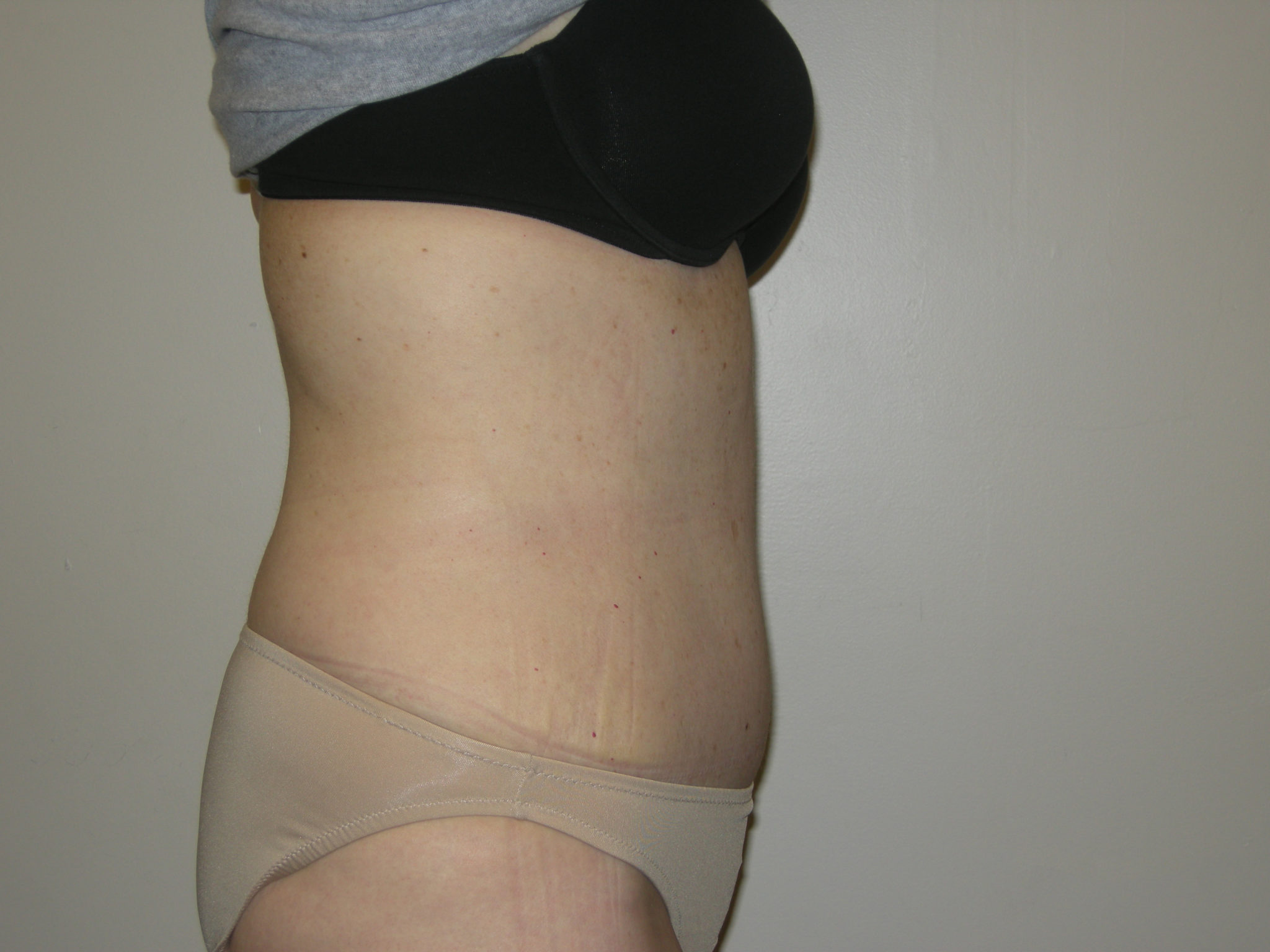 Tummy Tuck Patient Photo - Case 3454 - after view-3