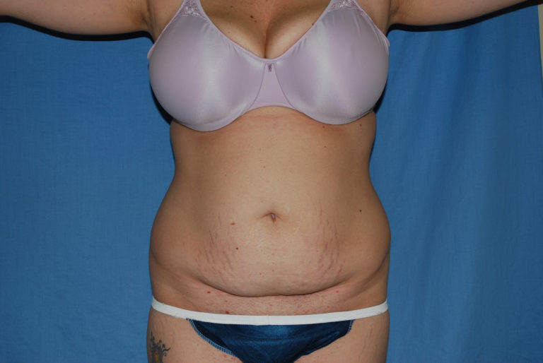 Tummy Tuck - Case 3332 - Before