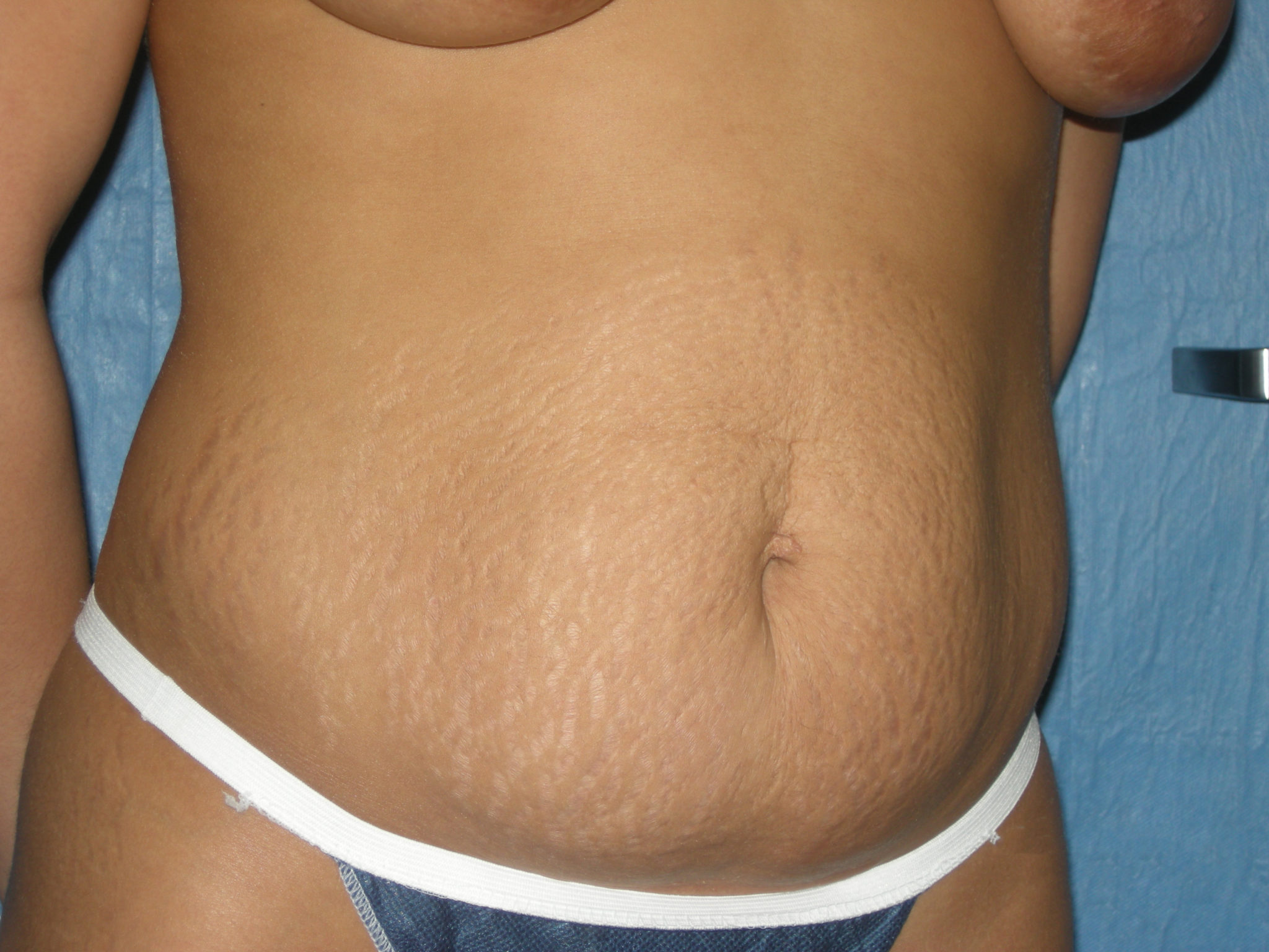 Liposuction Patient Photo - Case 3443 - before view-4