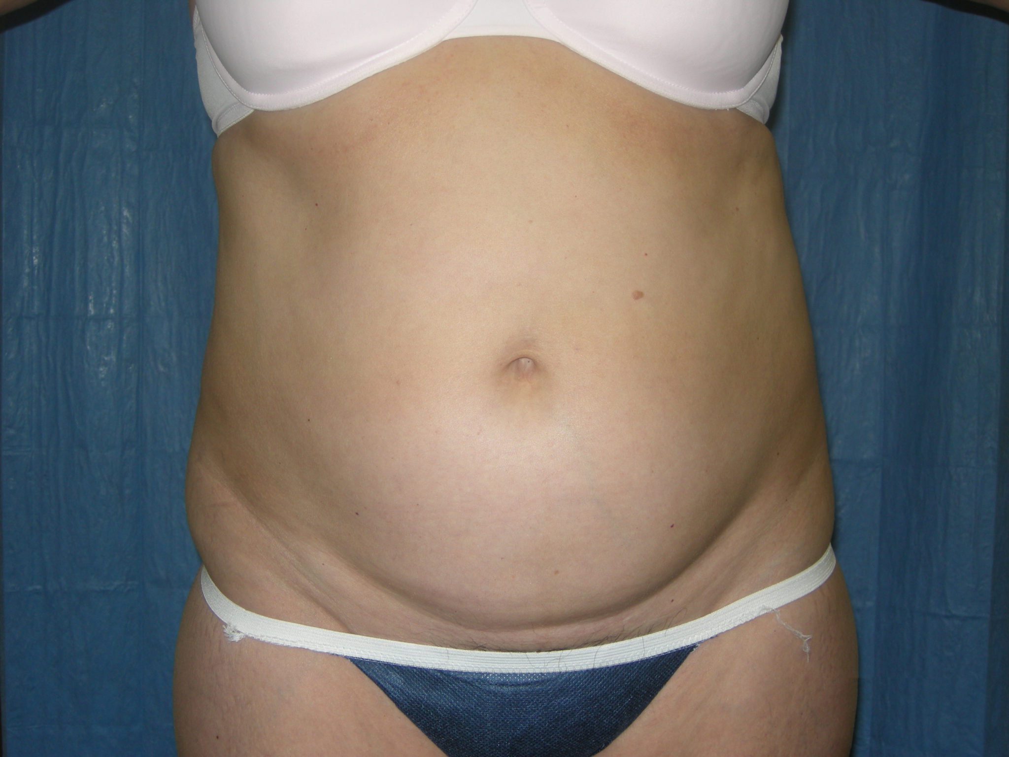 Liposuction Patient Photo - Case 3217 - before view-