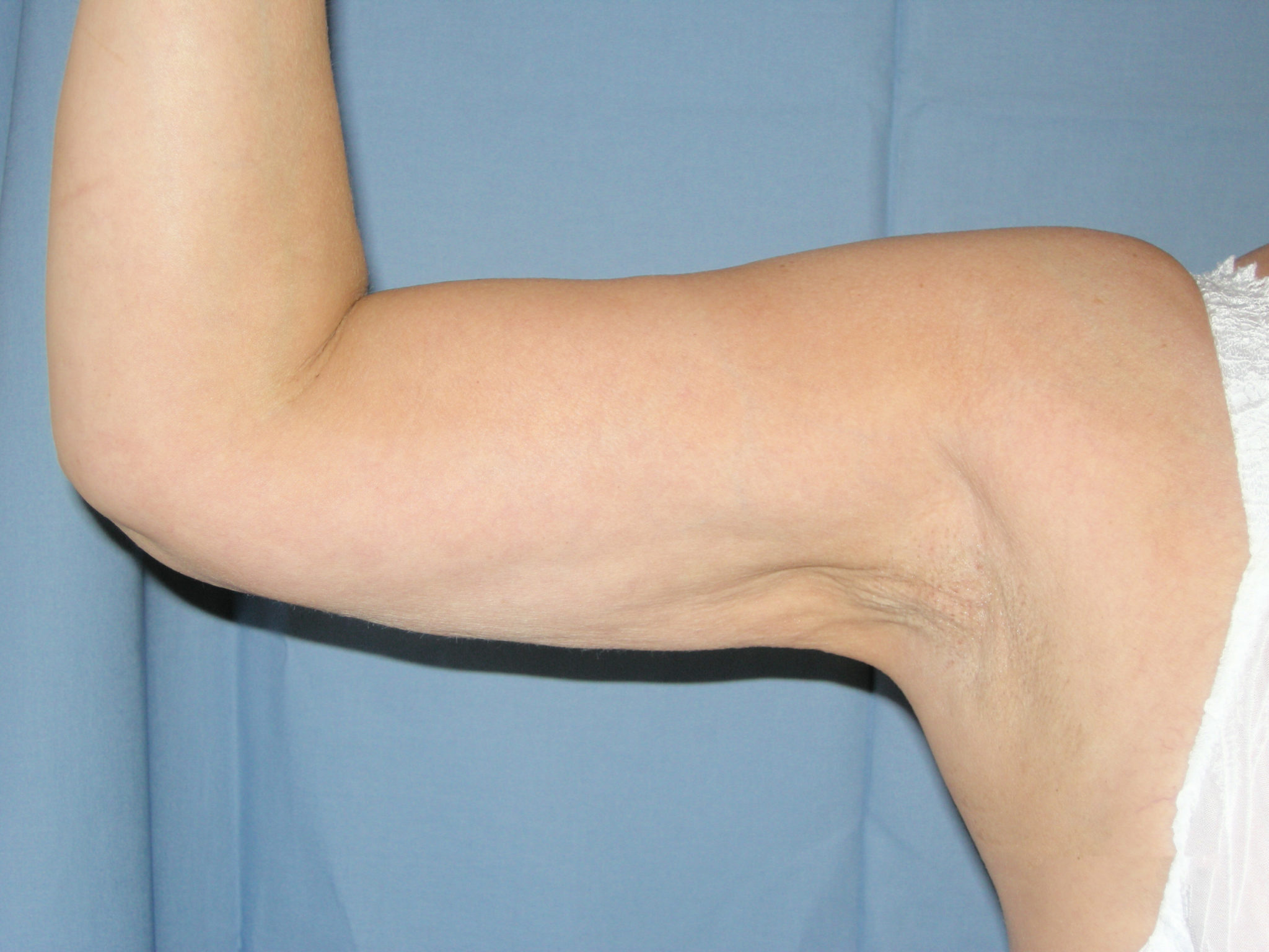 Liposuction Patient Photo - Case 3217 - after view-2