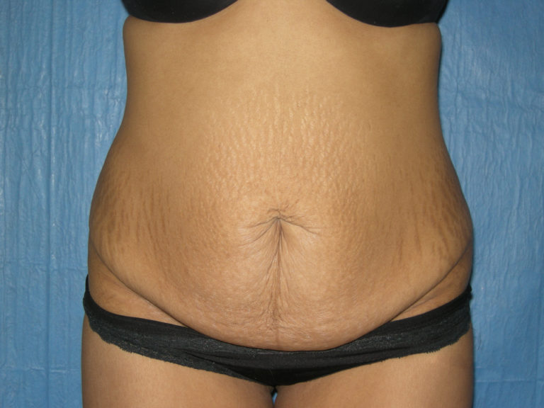 Tummy Tuck - Case 3465 - Before