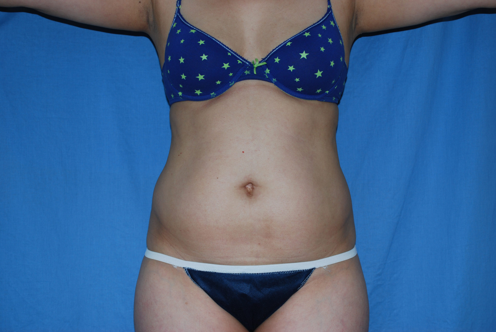 Liposuction Patient Photo - Case 3021 - before view-